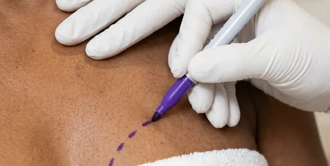 Breast Lift (Mastopexy)