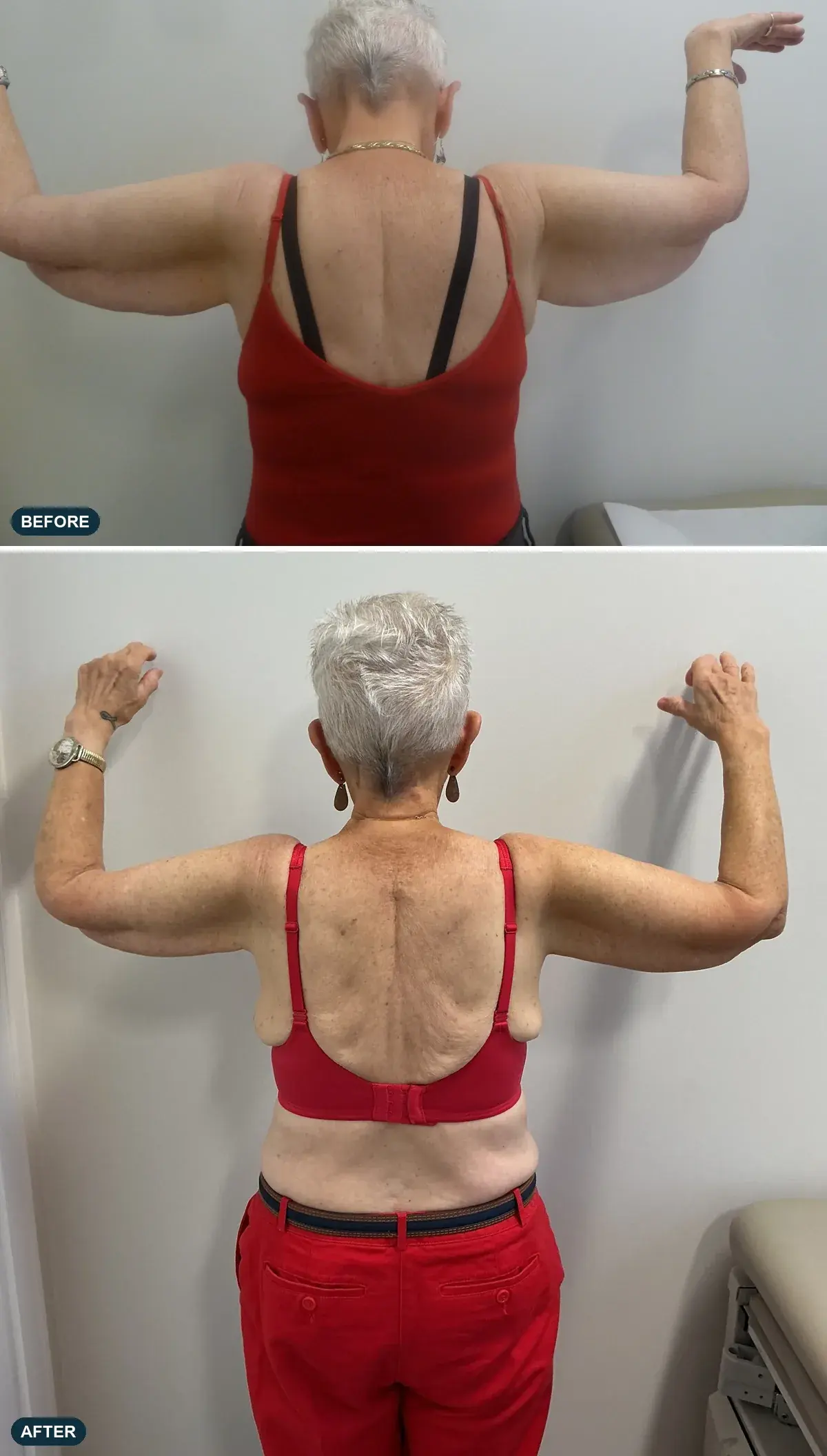 Upper Arms, back view, before and after at Barrie Plastic Surgery