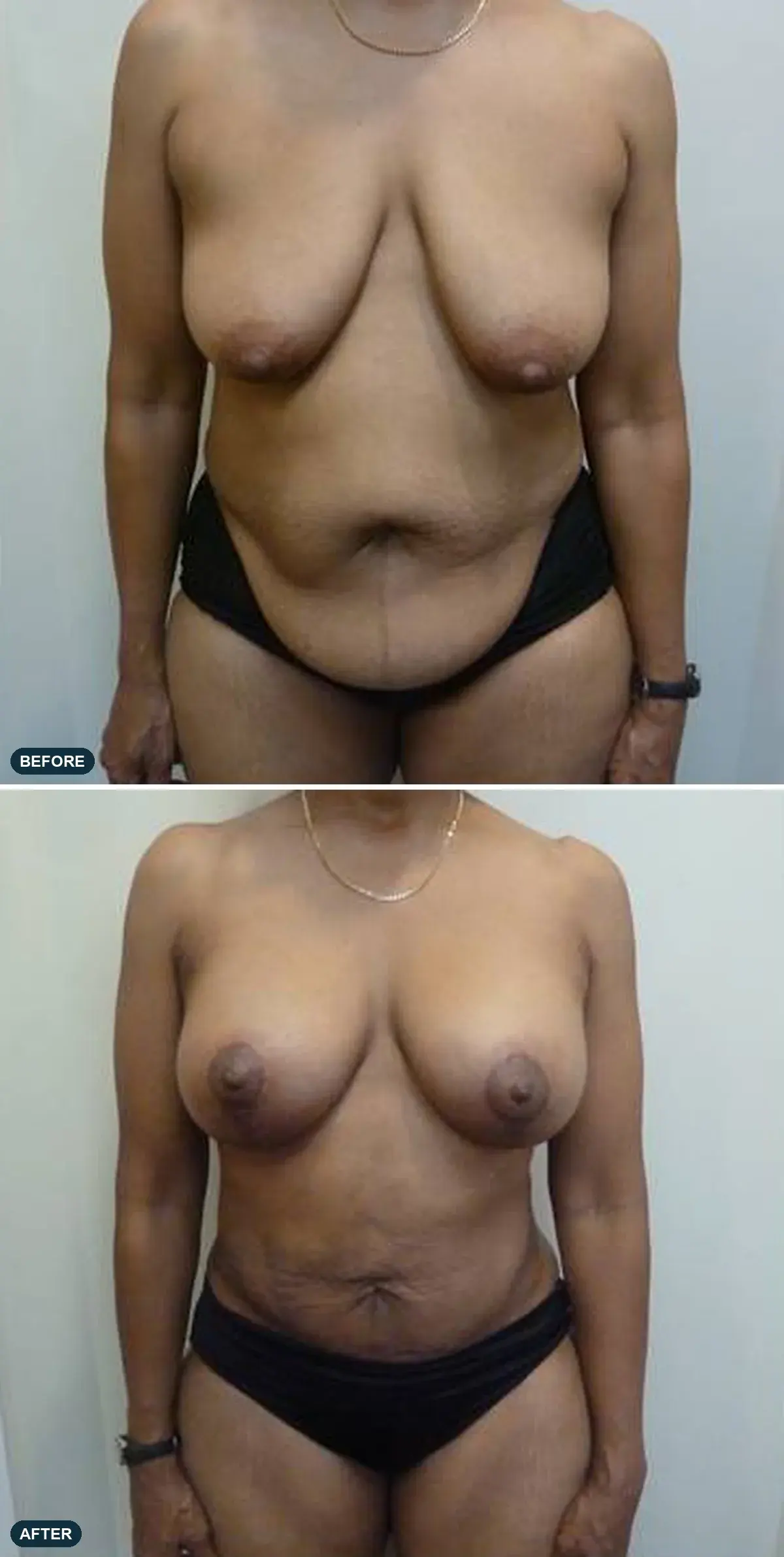 Breast & Abdomen, front view, before and after at Barrie Plastic Surgery
