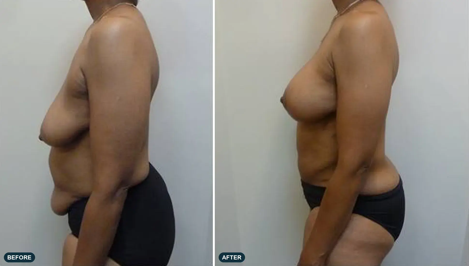 Breast & Abdomen, side view, before and after at Barrie Plastic Surgery