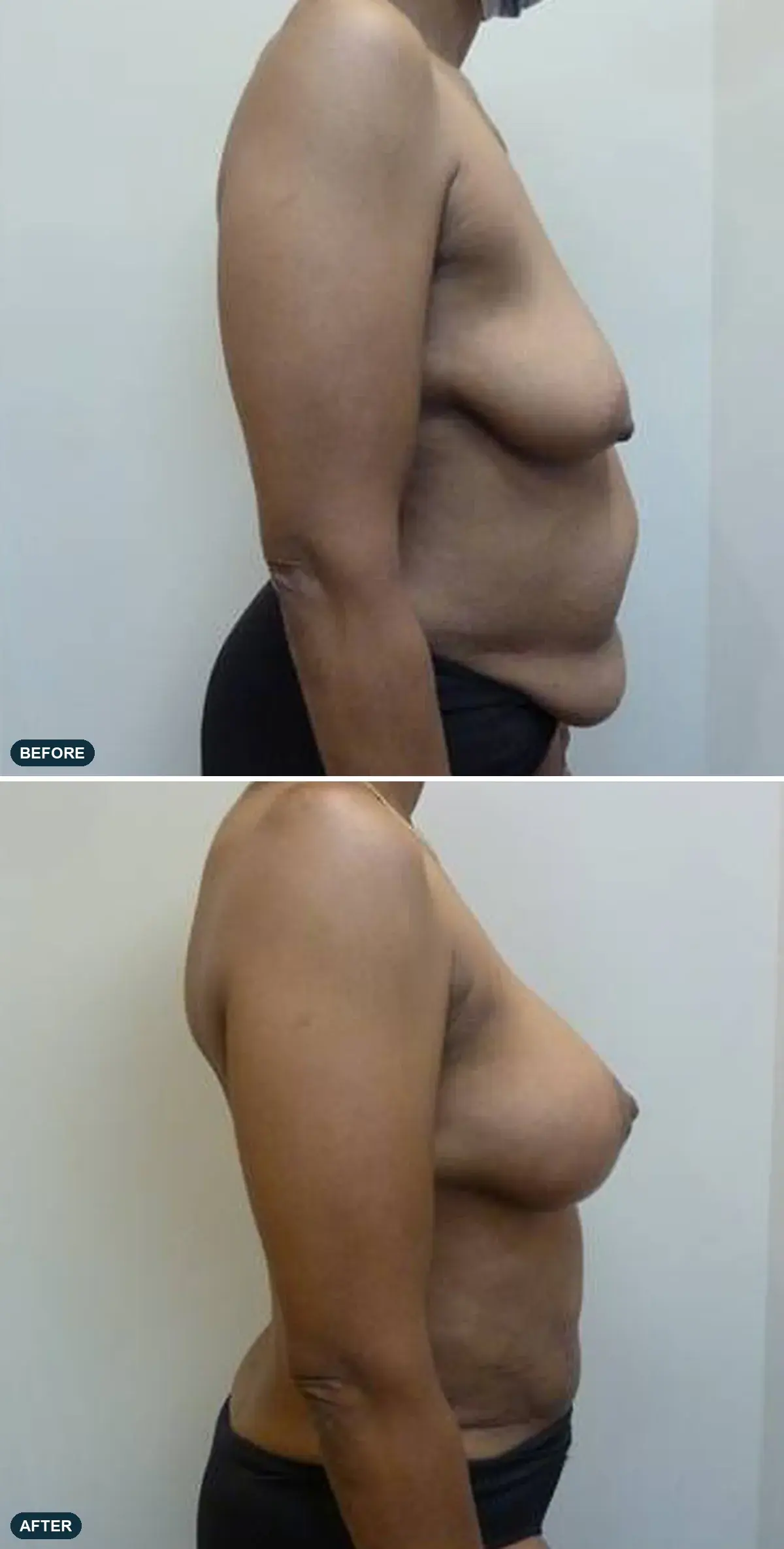 Breast & Abdomen, side view, before and after at Barrie Plastic Surgery