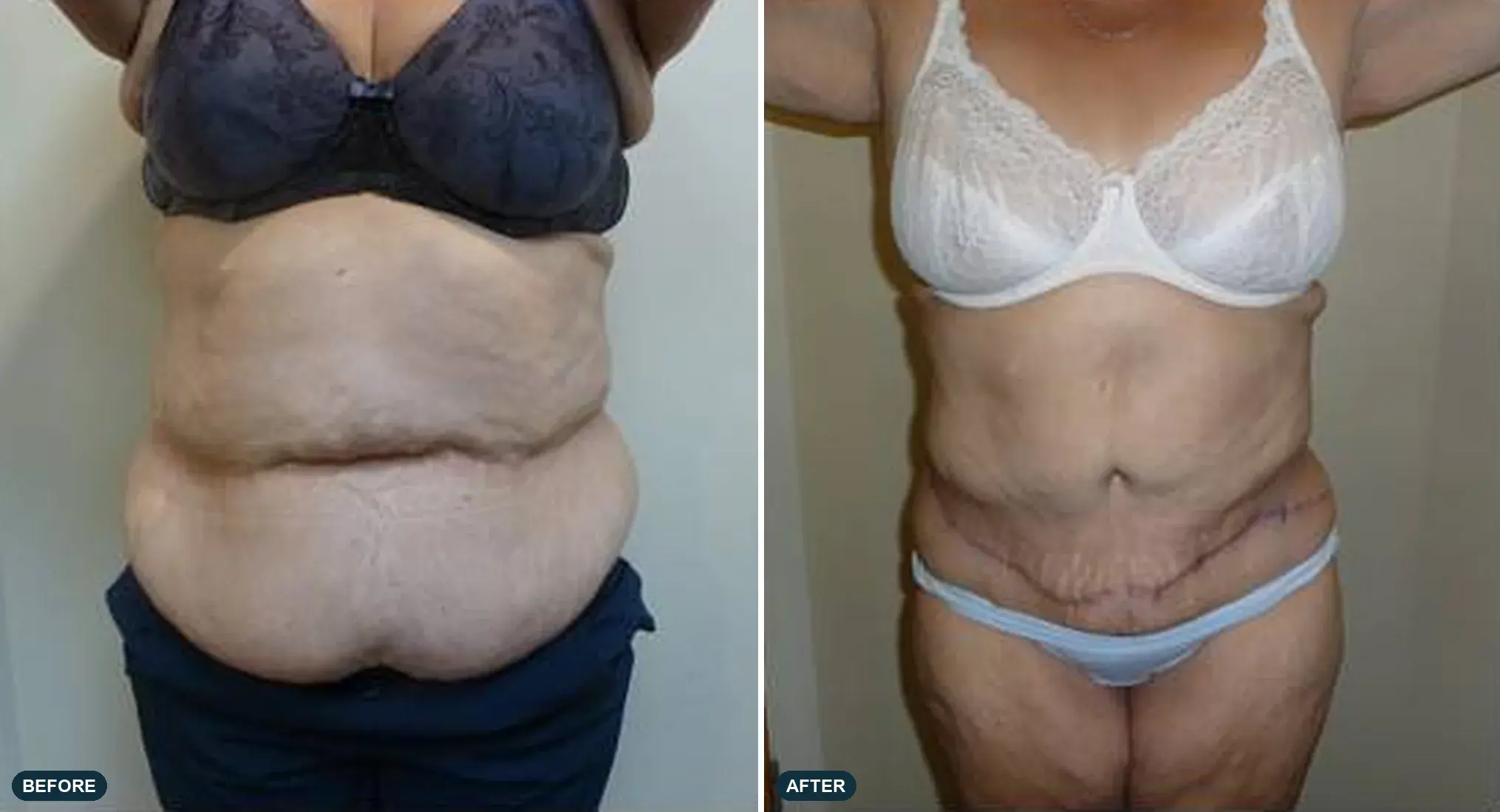Abdomen, front view, before and after at Barrie Plastic Surgery