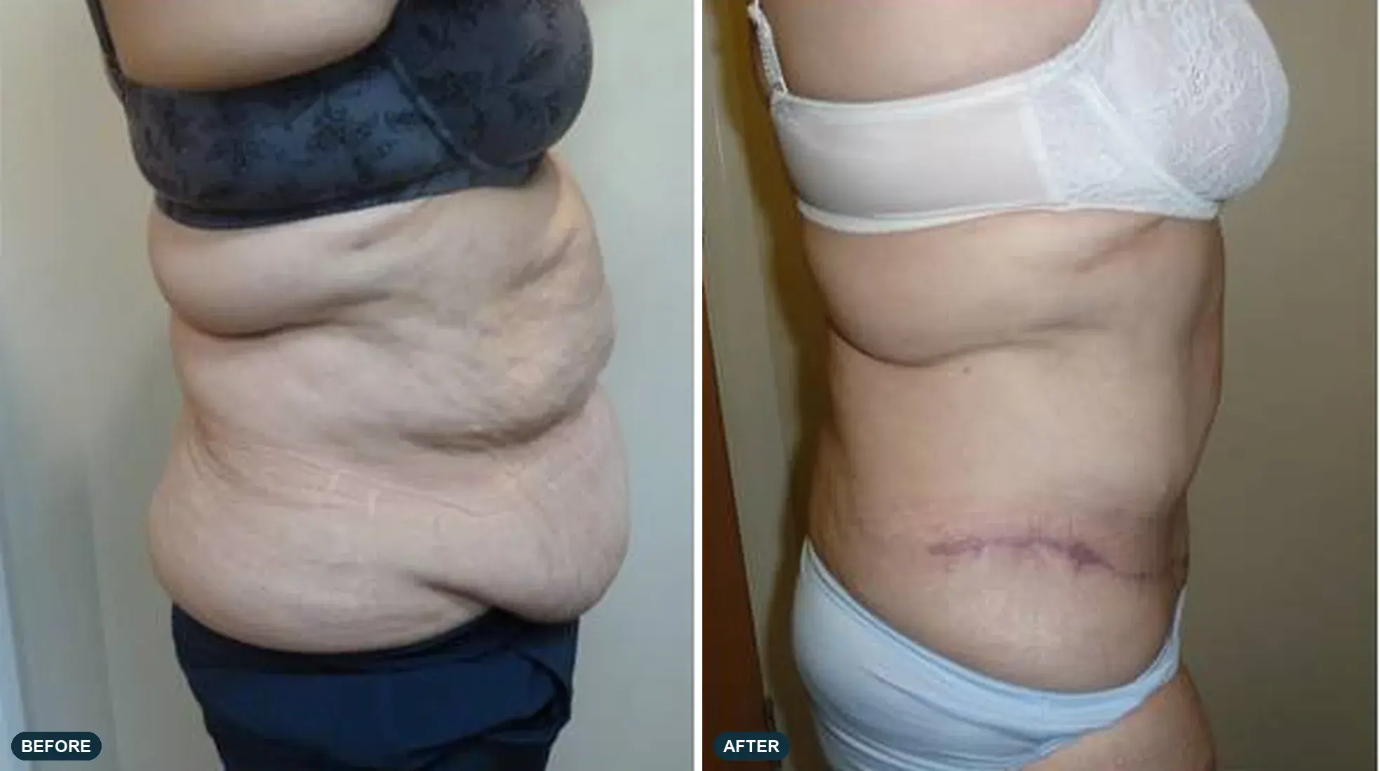 Abdomen, oblique view, before and after at Barrie Plastic Surgery