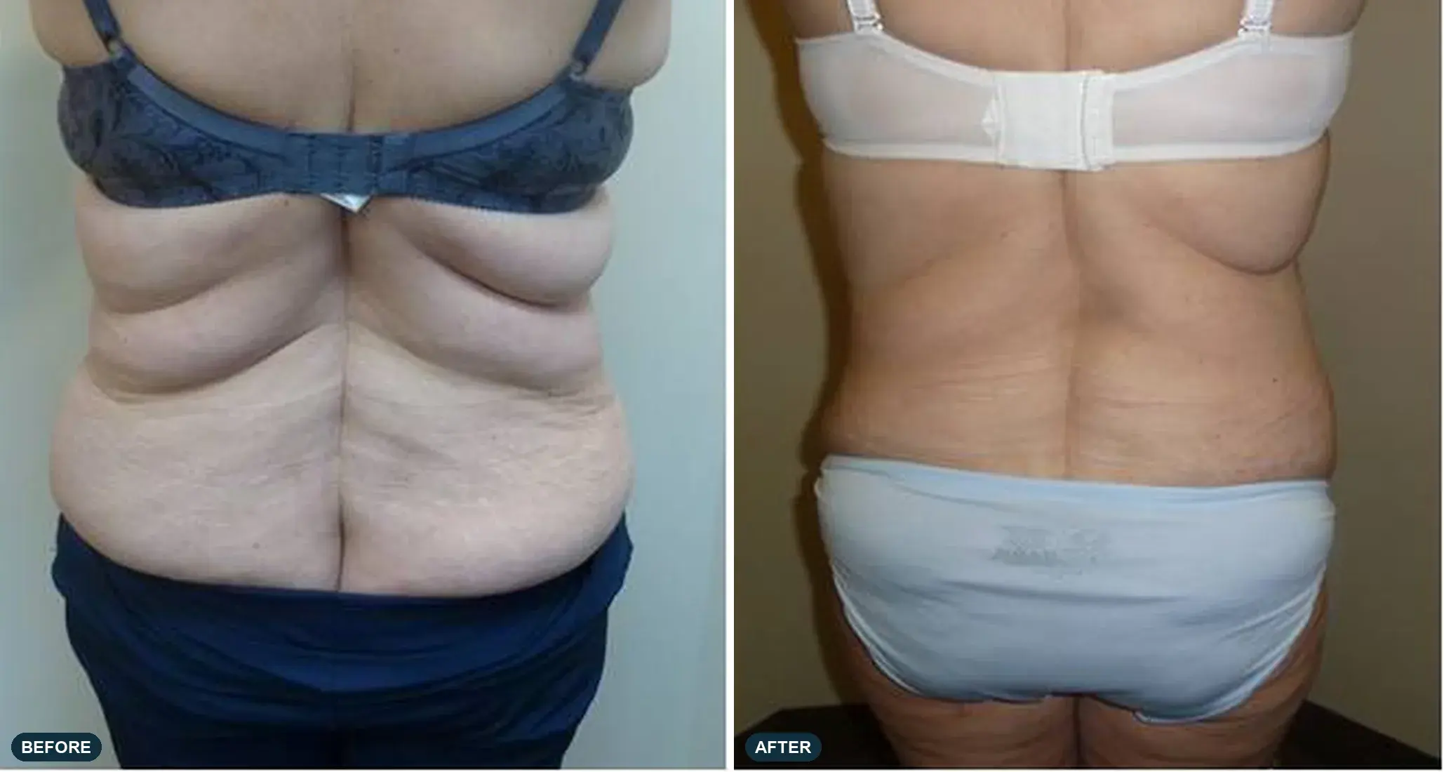 Abdomen, back view, before and after at Barrie Plastic Surgery