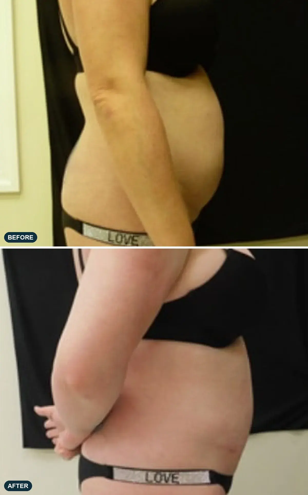 Abdomen & Flanks, side view, before and after at Barrie Plastic Surgery
