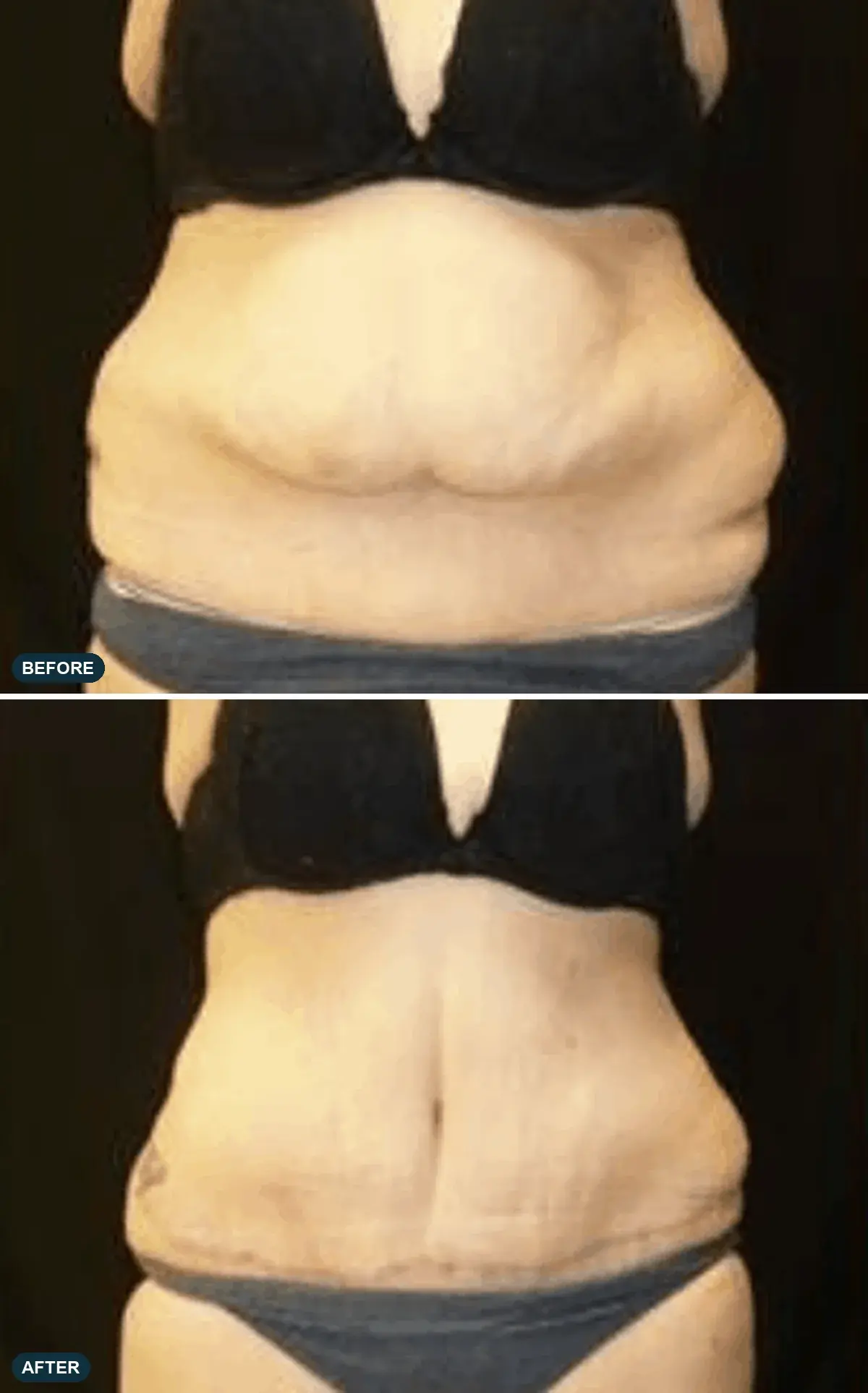Abdomen, front view, before and after at Barrie Plastic Surgery