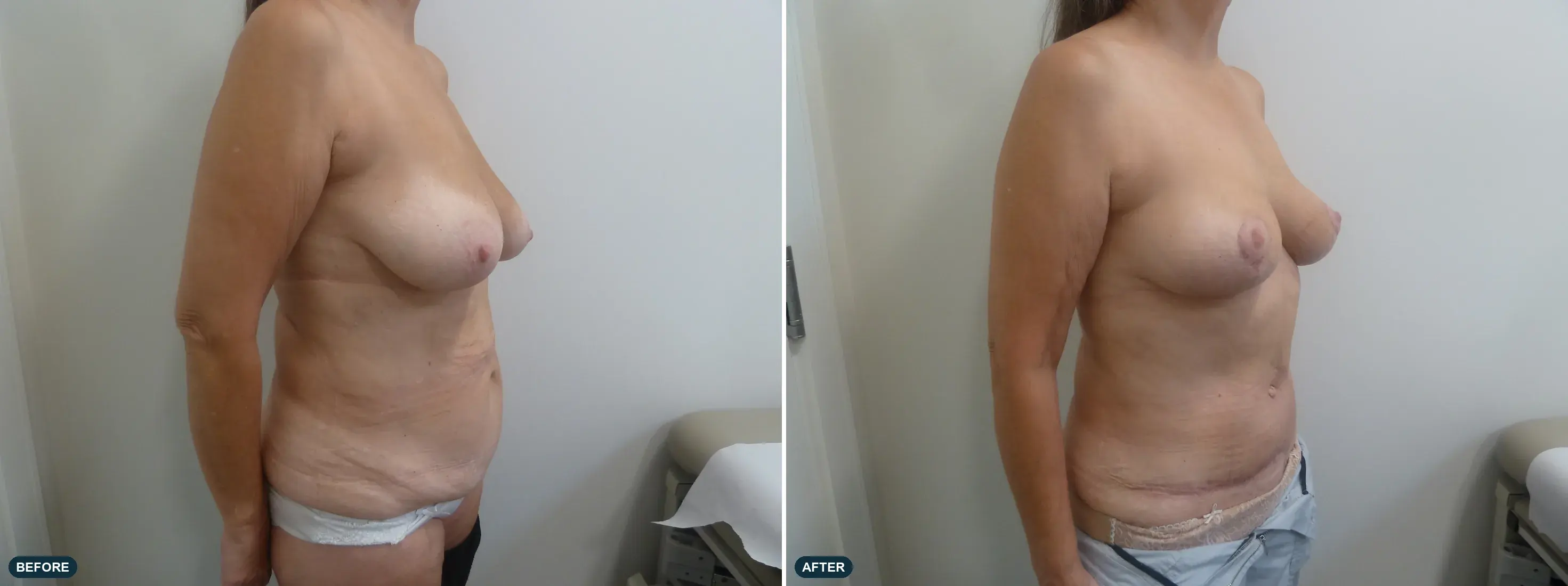 Breast & Abdomen, side view, before and after at Barrie Plastic Surgery