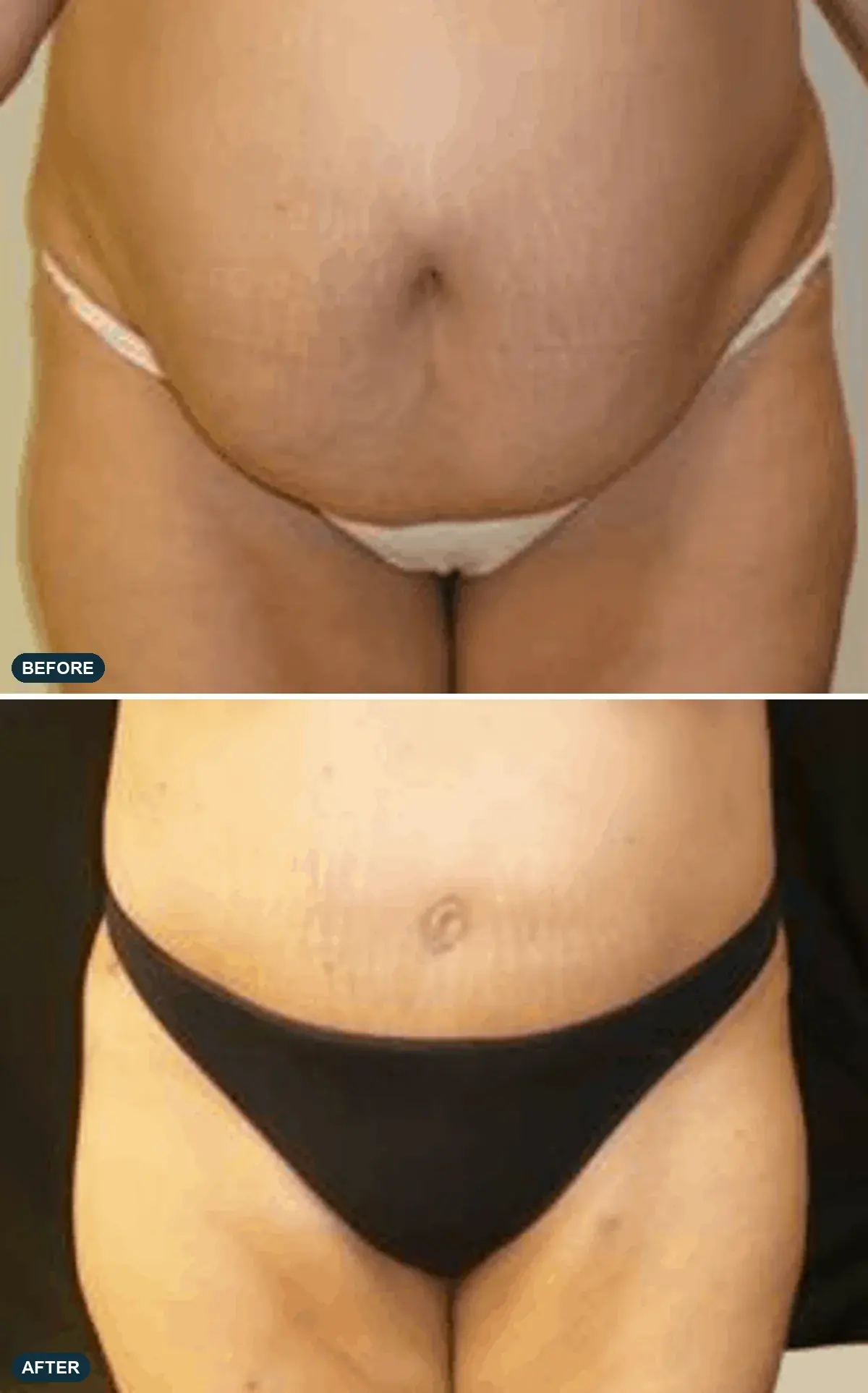 Abdomen, front view, before and after at Barrie Plastic Surgery