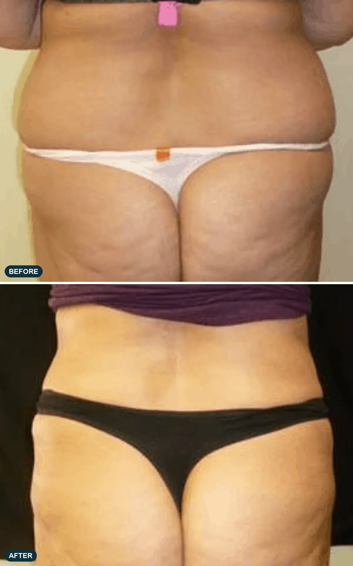 Abdomen & Flanks, back view, before and after at Barrie Plastic Surgery