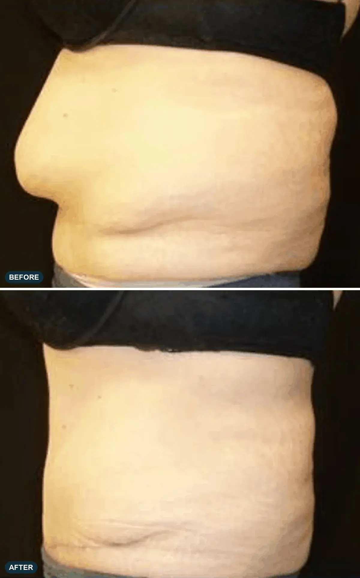 Abdomen, side view, before and after at Barrie Plastic Surgery