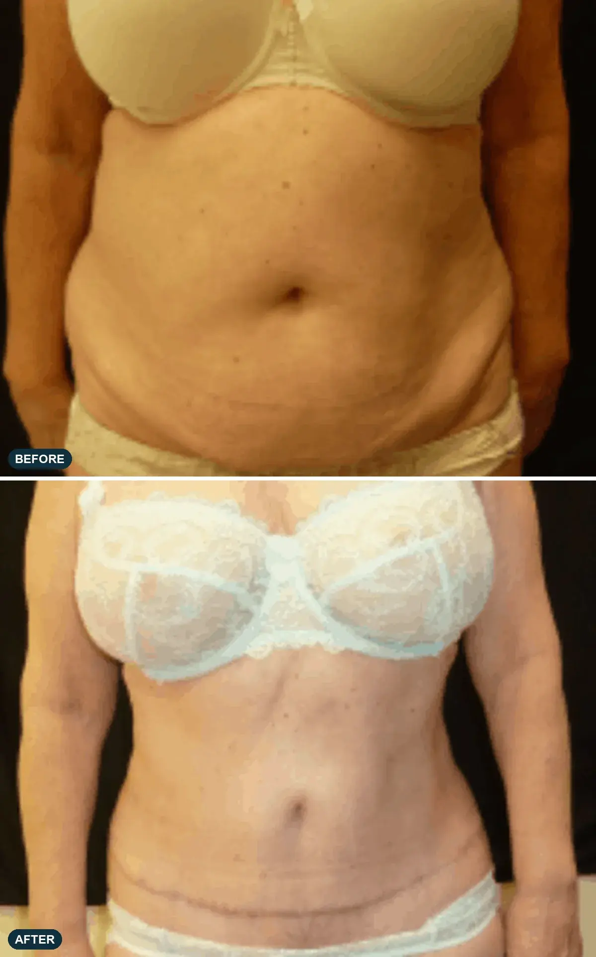 Lower Abdomen, front view, before and after at Barrie Plastic Surgery