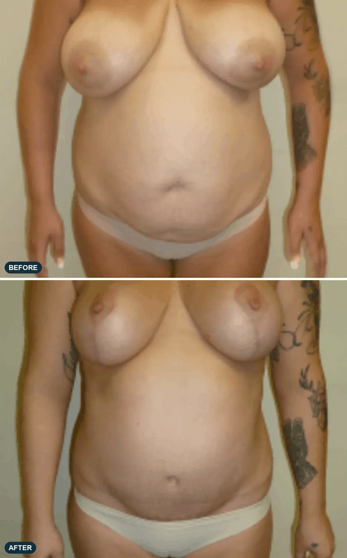 Breast & Abdomen, front view, before and after at Barrie Plastic Surgery