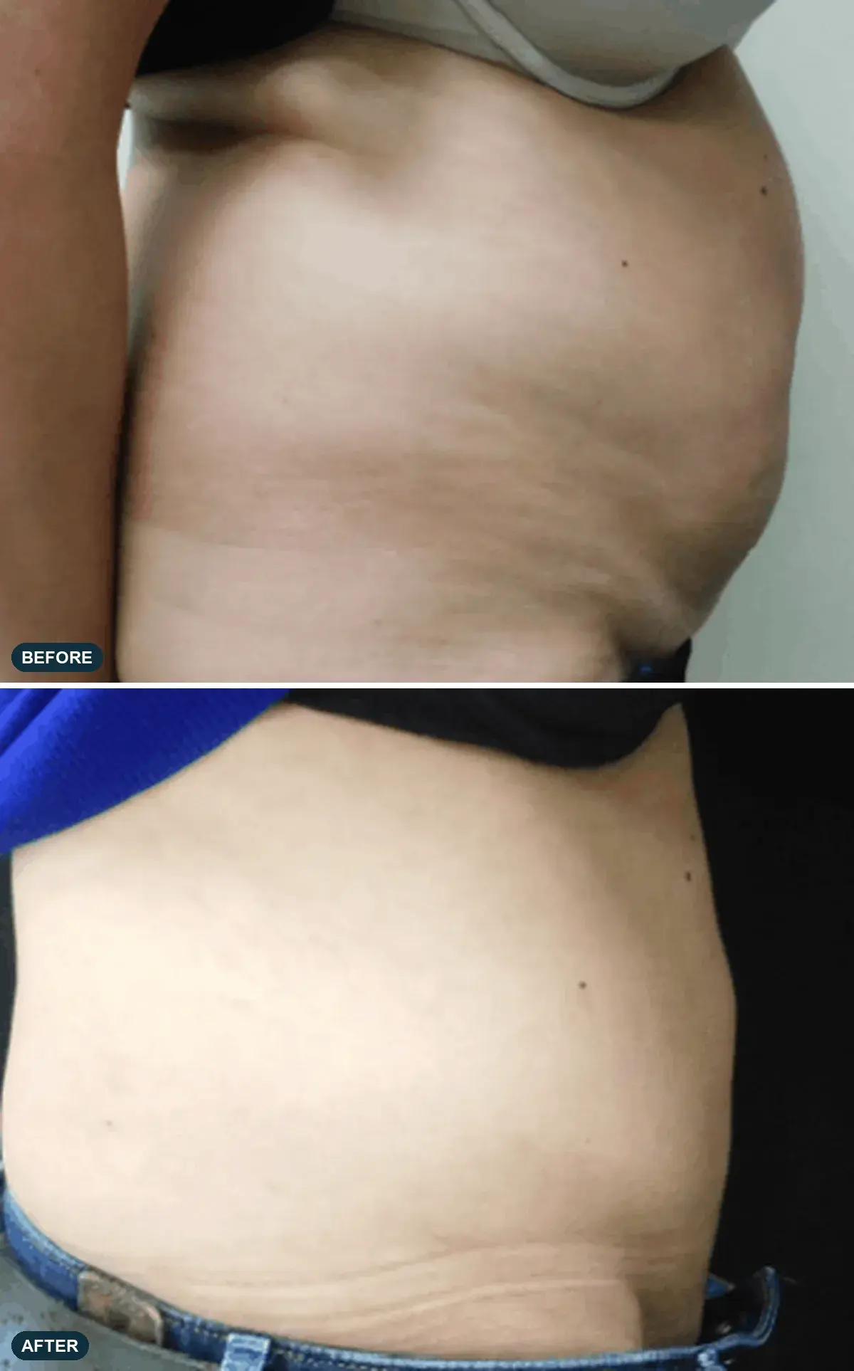 Abdomen, side view, before and after at Barrie Plastic Surgery