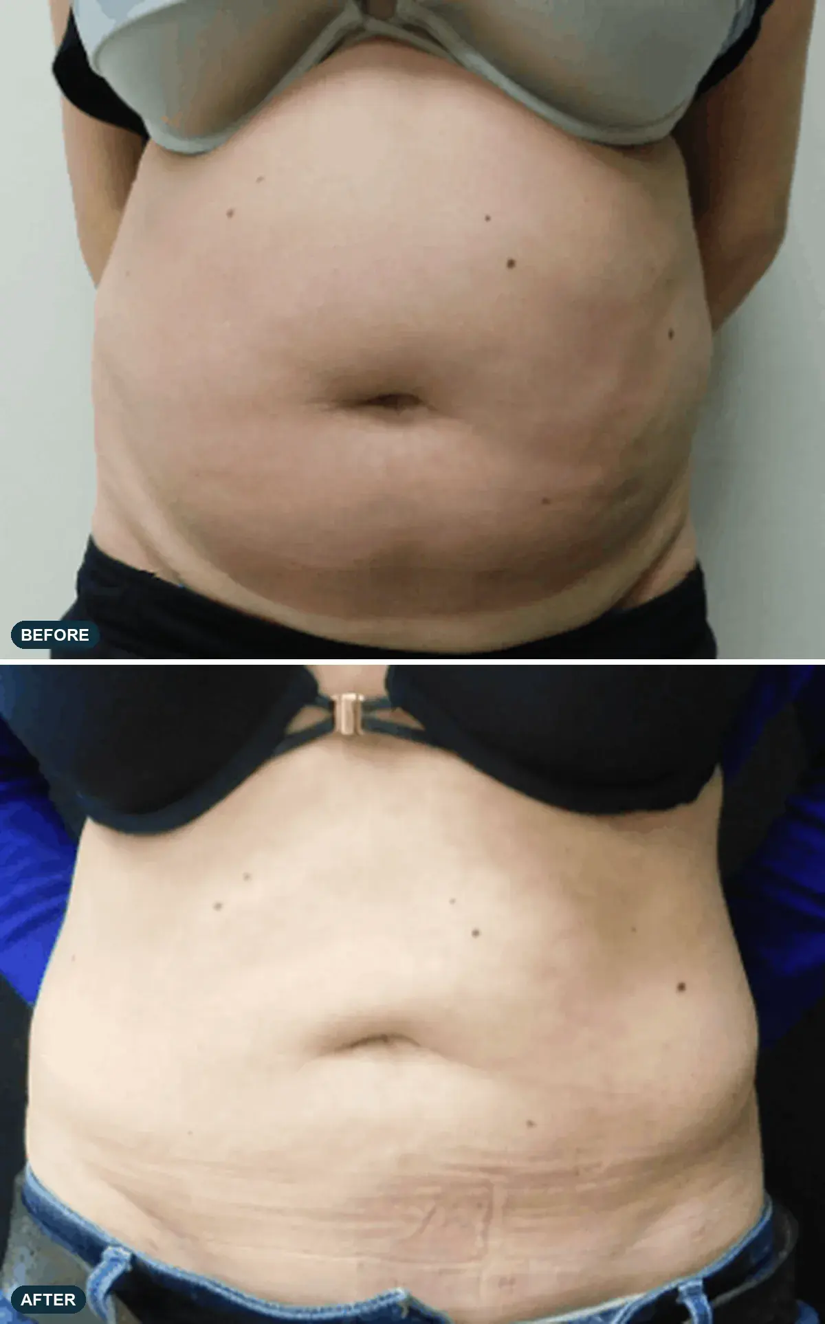Abdomen, front view, before and after at Barrie Plastic Surgery