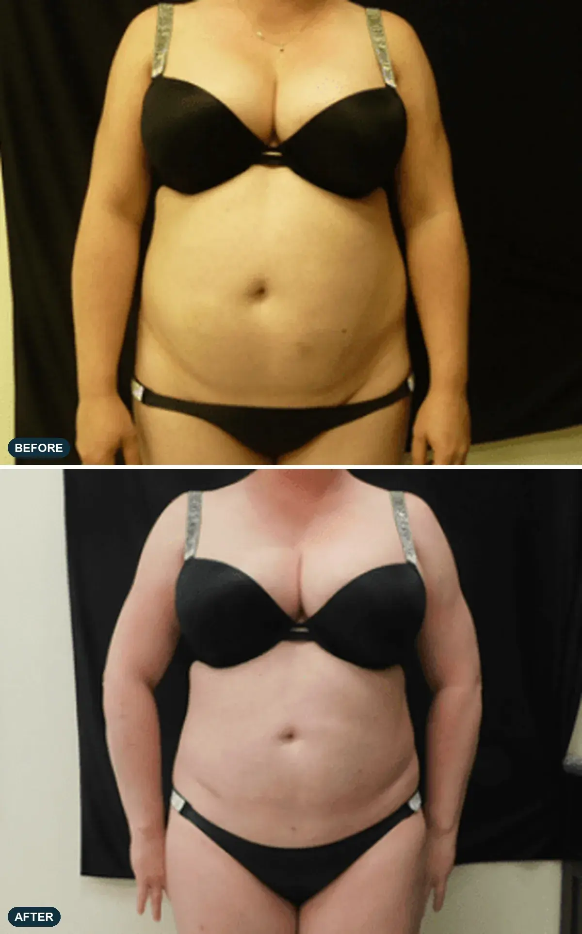 Abdomen & Waist, front view, before and after at Barrie Plastic Surgery