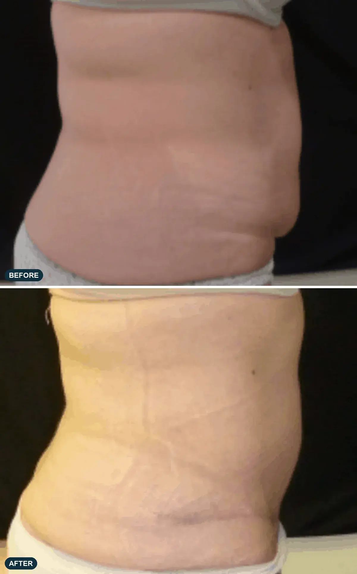 Abdomen, front view, before and after at Barrie Plastic Surgery