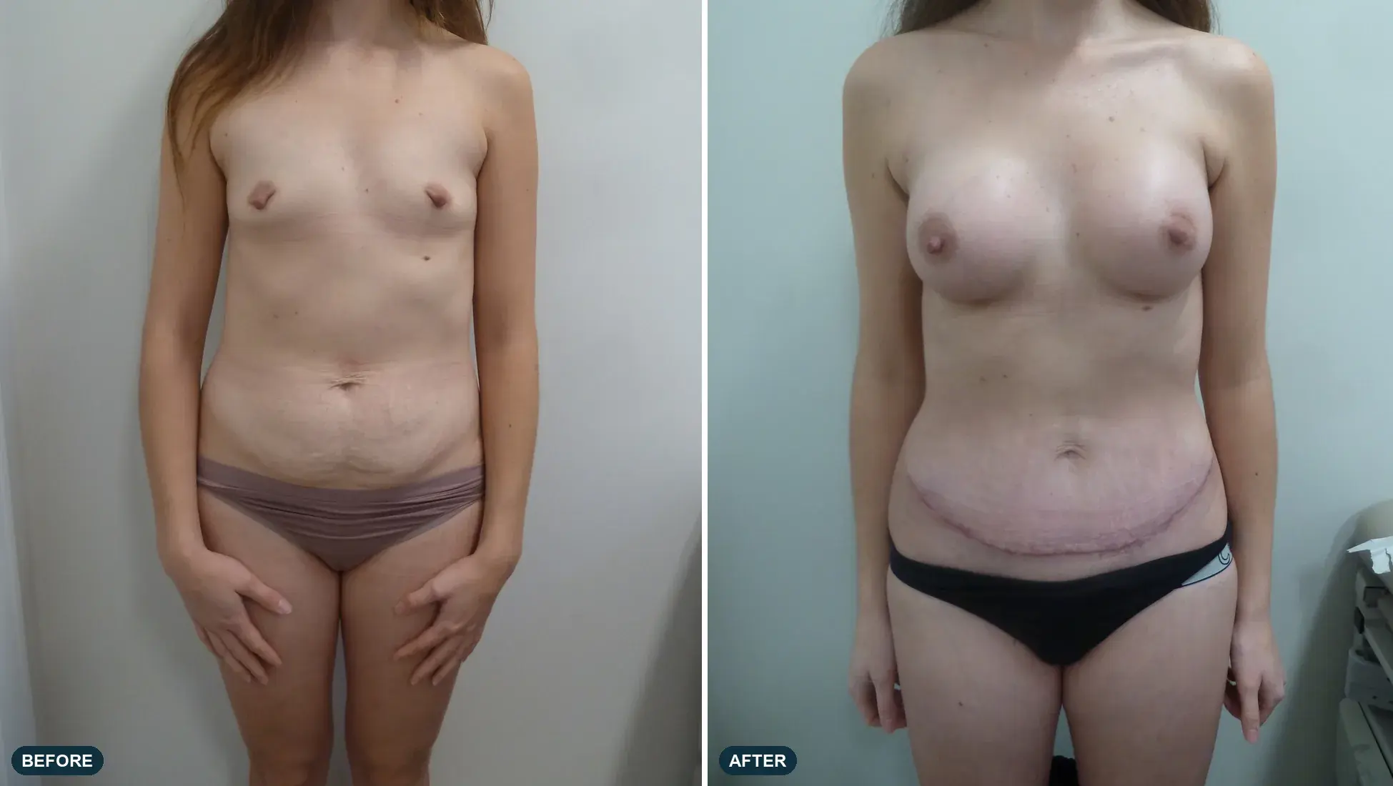 Breast & Abdomen, front view, before and after at Barrie Plastic Surgery