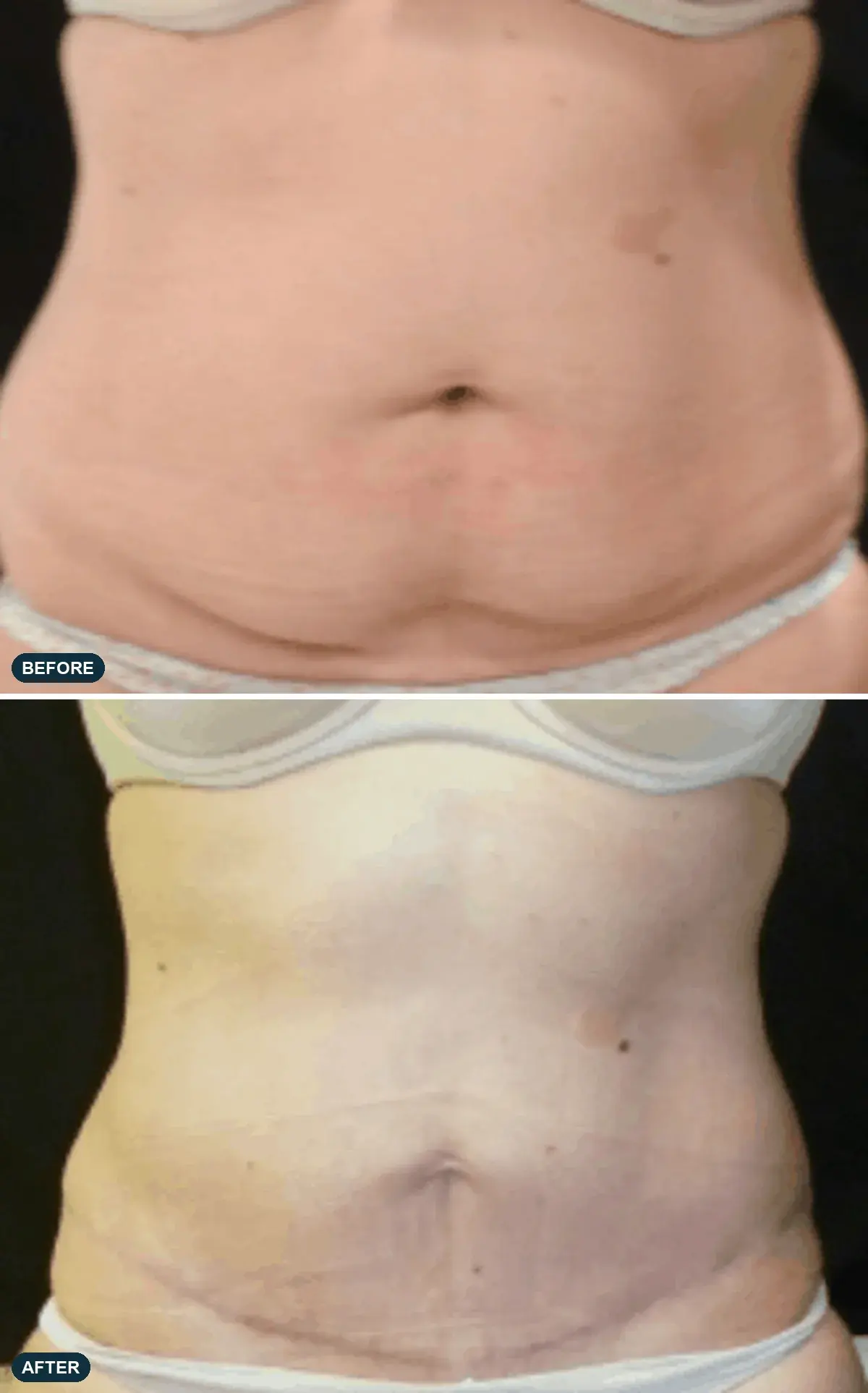 Abdomen, front view, before and after at Barrie Plastic Surgery