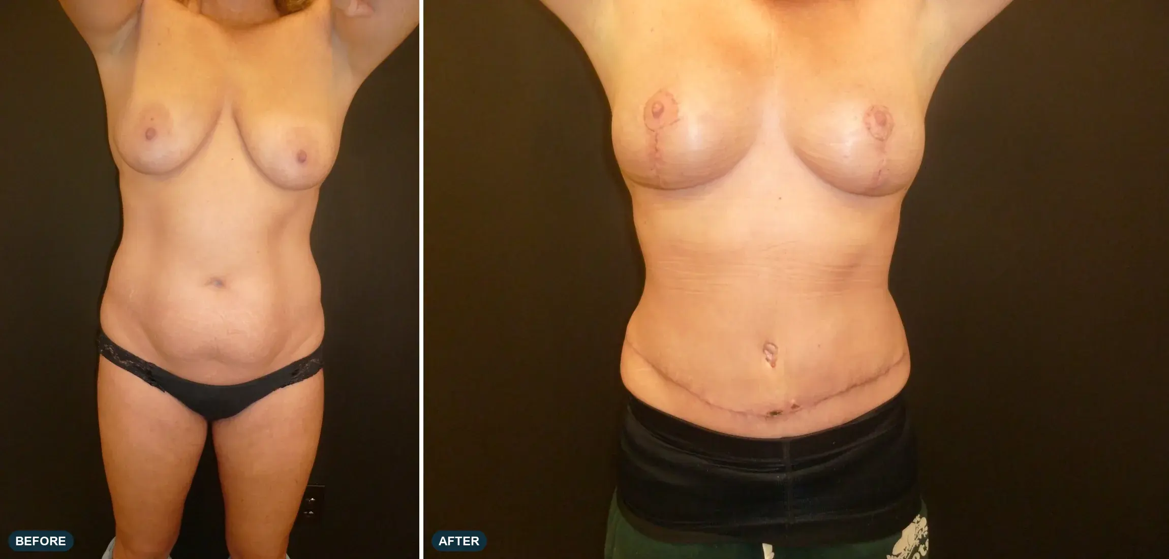 Breast & Abdomen, front view, before and after at Barrie Plastic Surgery