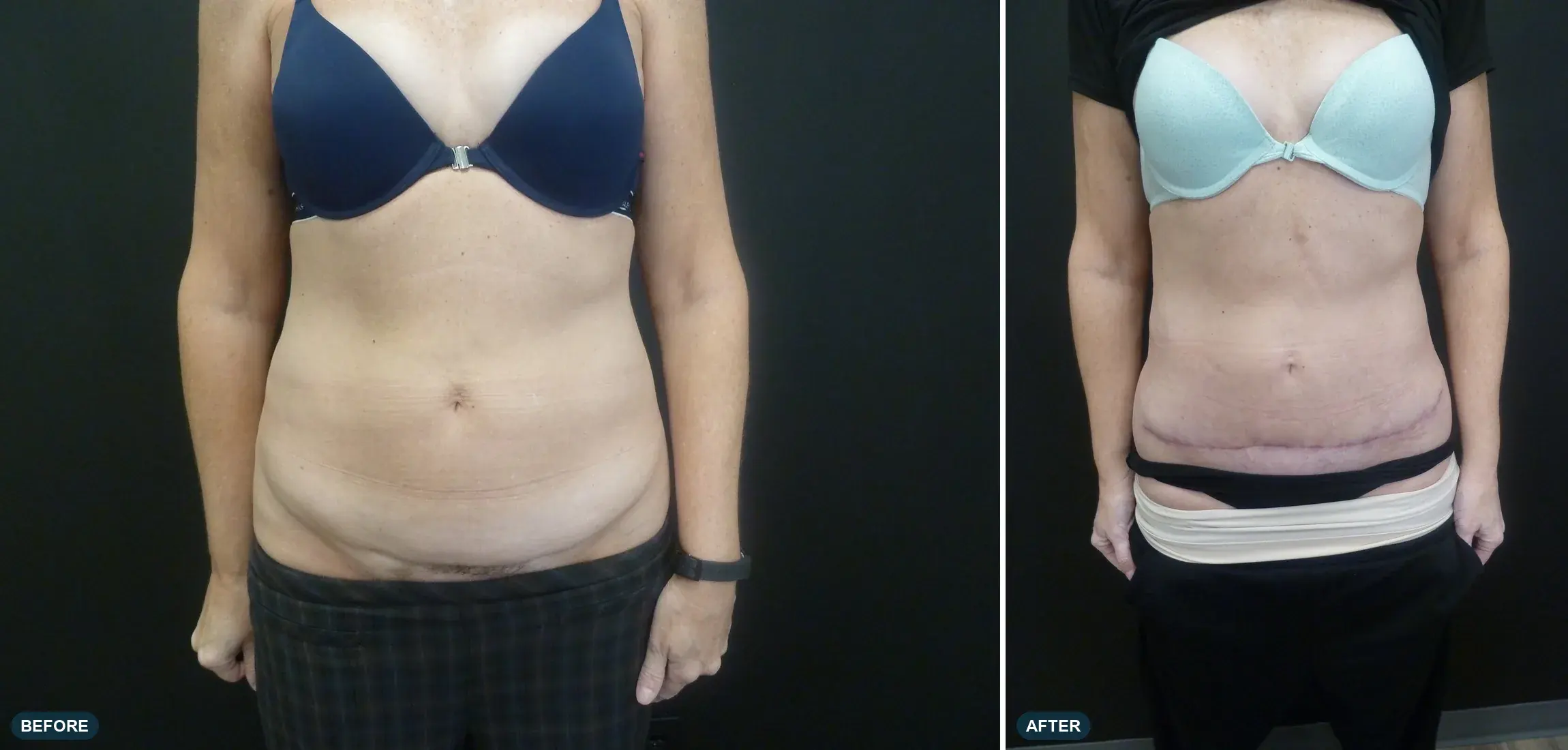 Abdomen, front view, before and after at Barrie Plastic Surgery