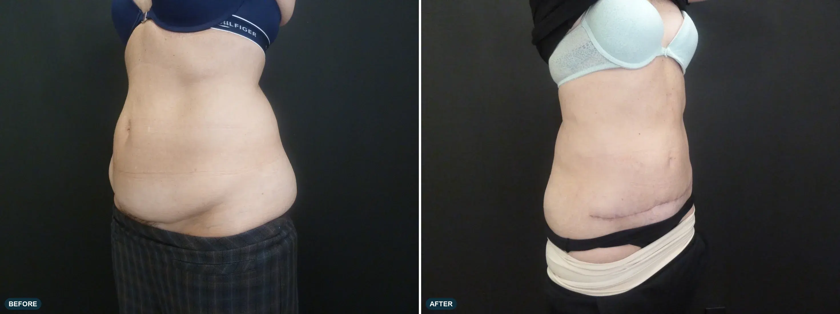 Abdomen, side view, before and after at Barrie Plastic Surgery