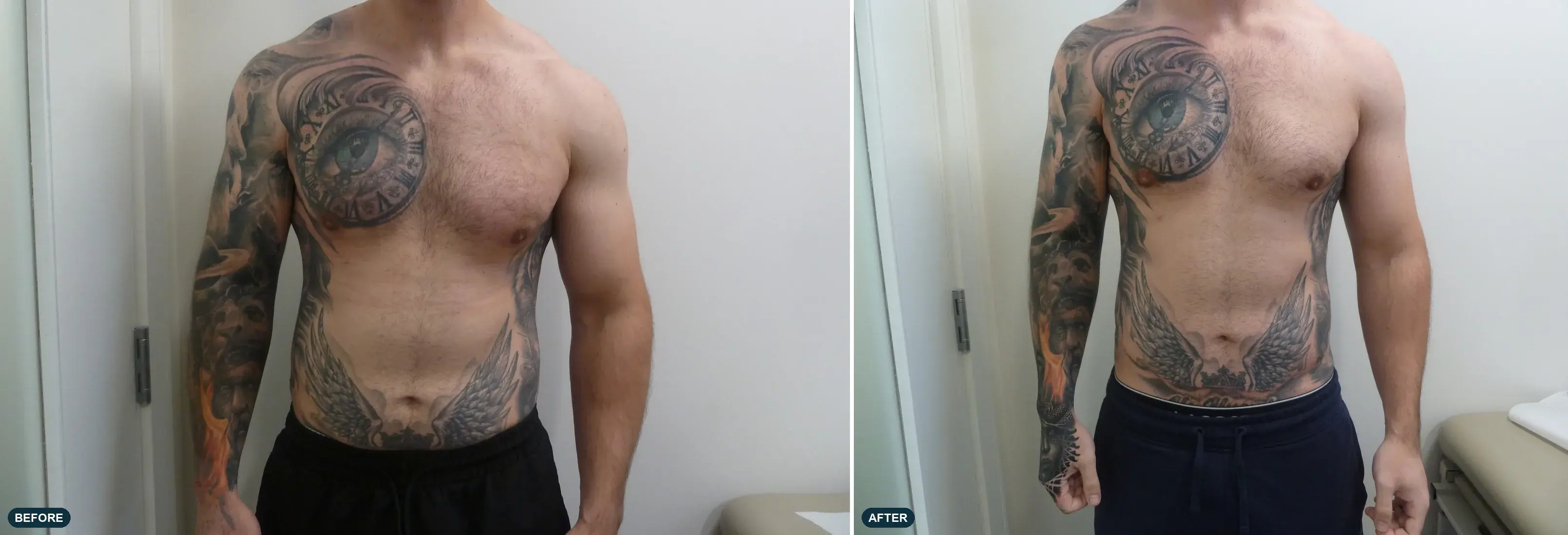 Abdomen & Flanks, front view, before and after at Barrie Plastic Surgery