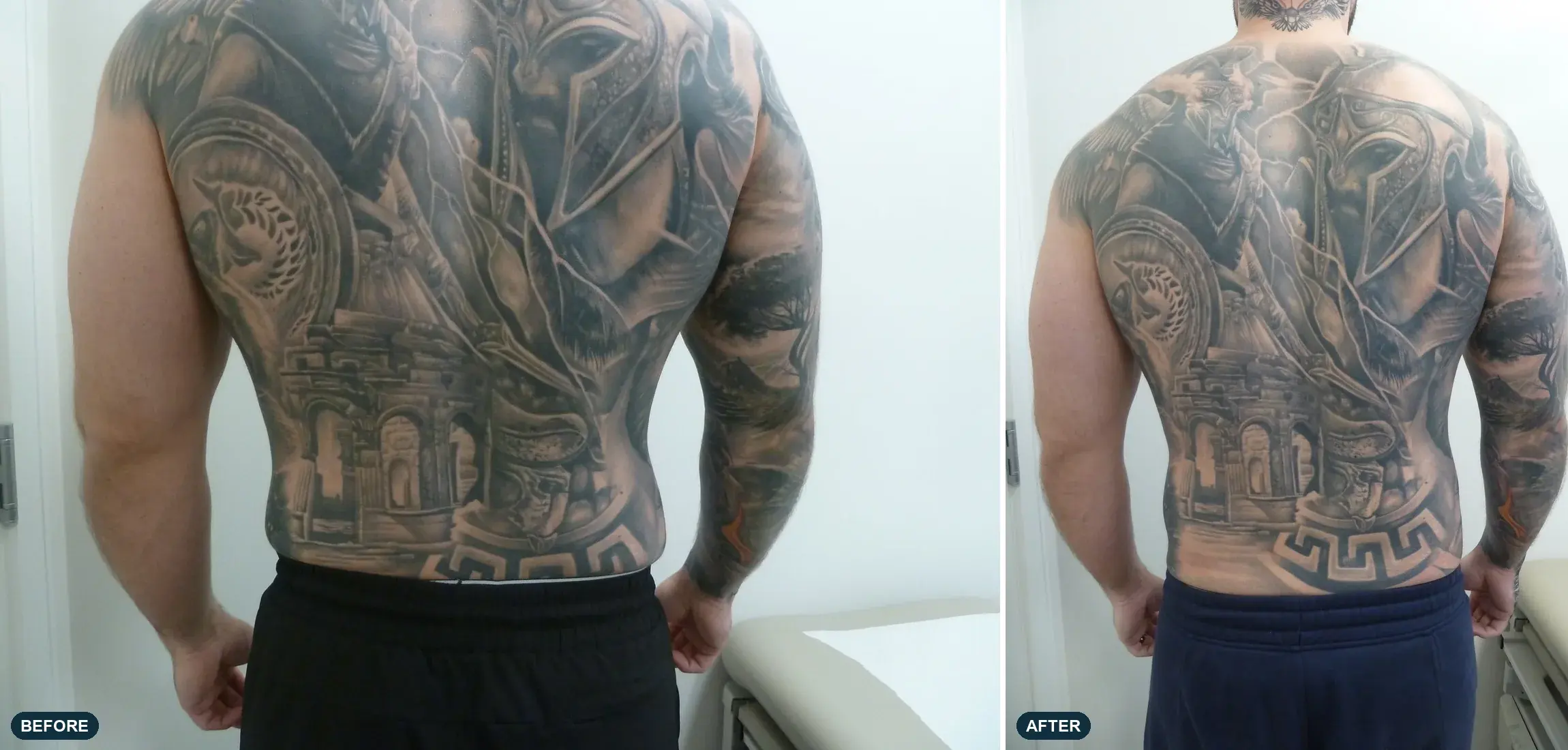 Abdomen & Flanks, back view, before and after at Barrie Plastic Surgery