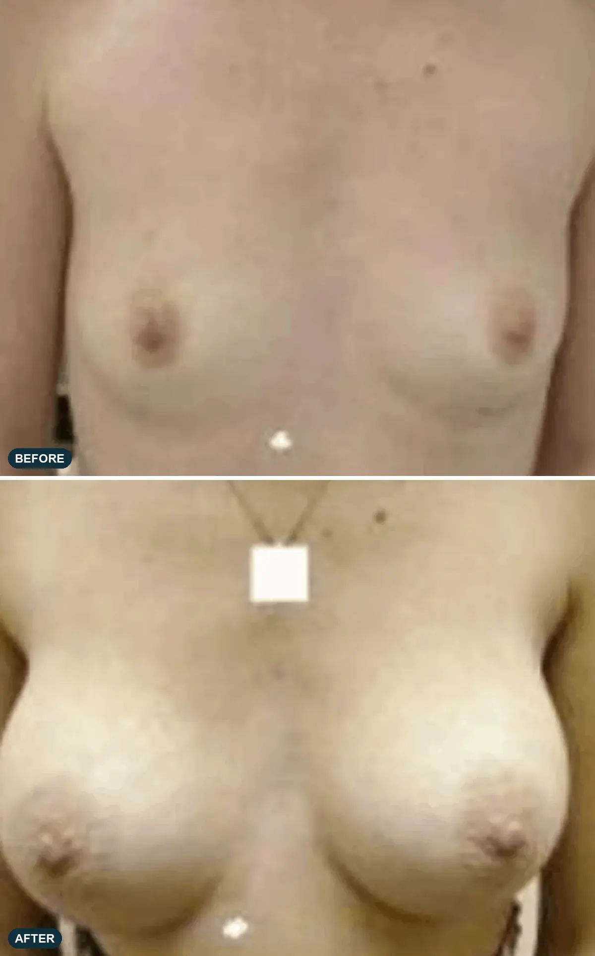 Breast, front view, before and after at Barrie Plastic Surgery