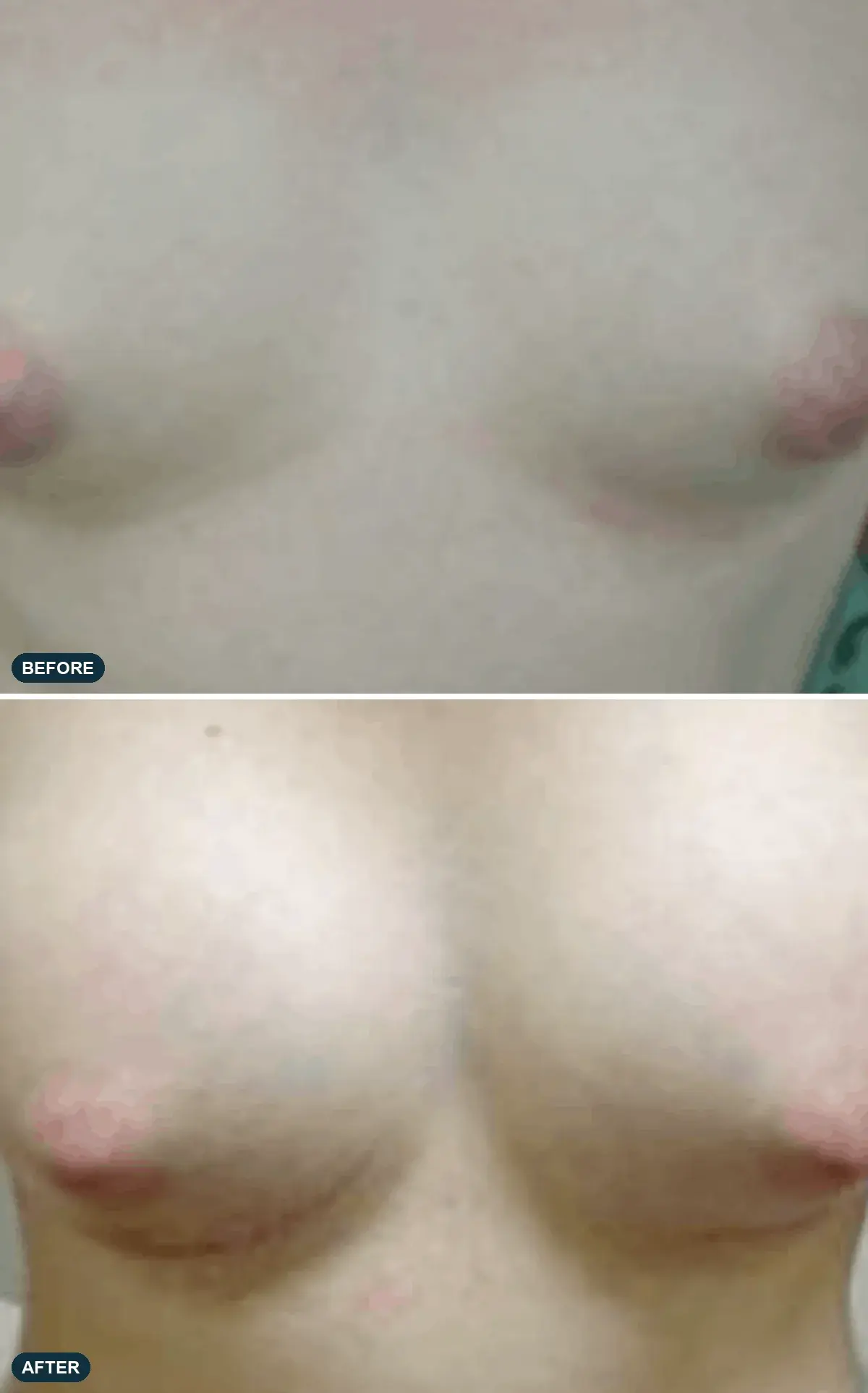 Breast, front view, before and after at Barrie Plastic Surgery