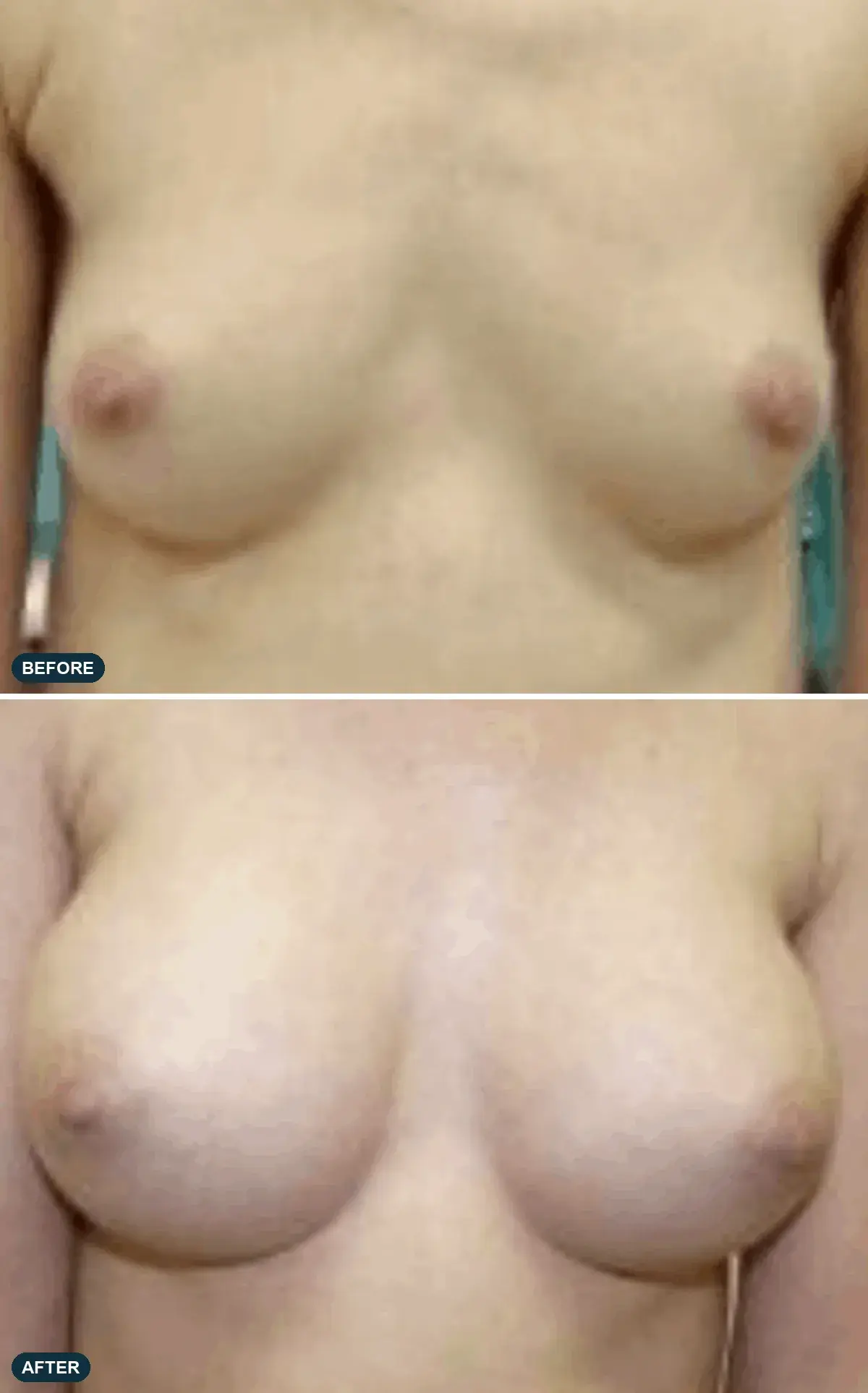 Breast, front view, before and after at Barrie Plastic Surgery