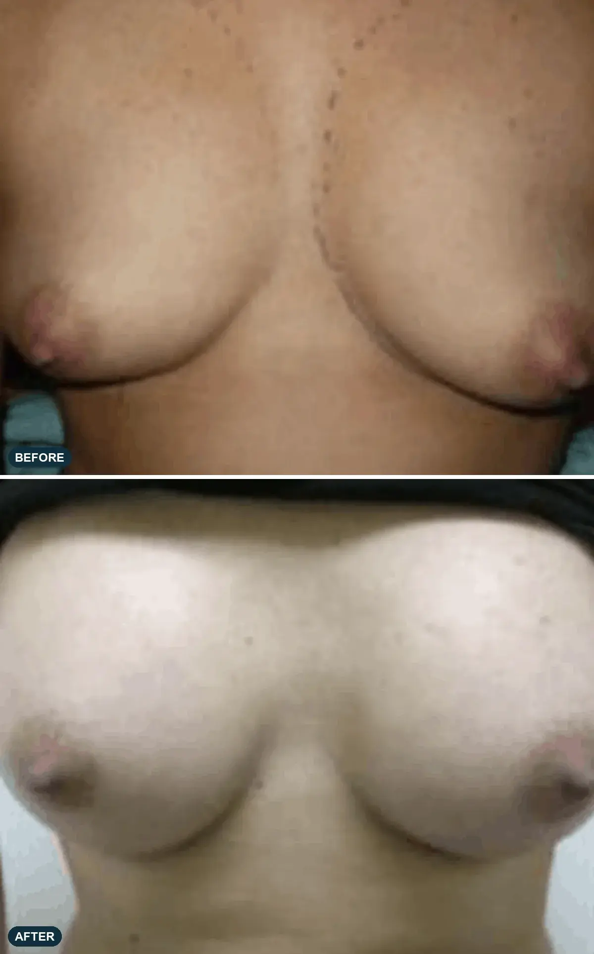 Breast, front view, before and after at Barrie Plastic Surgery