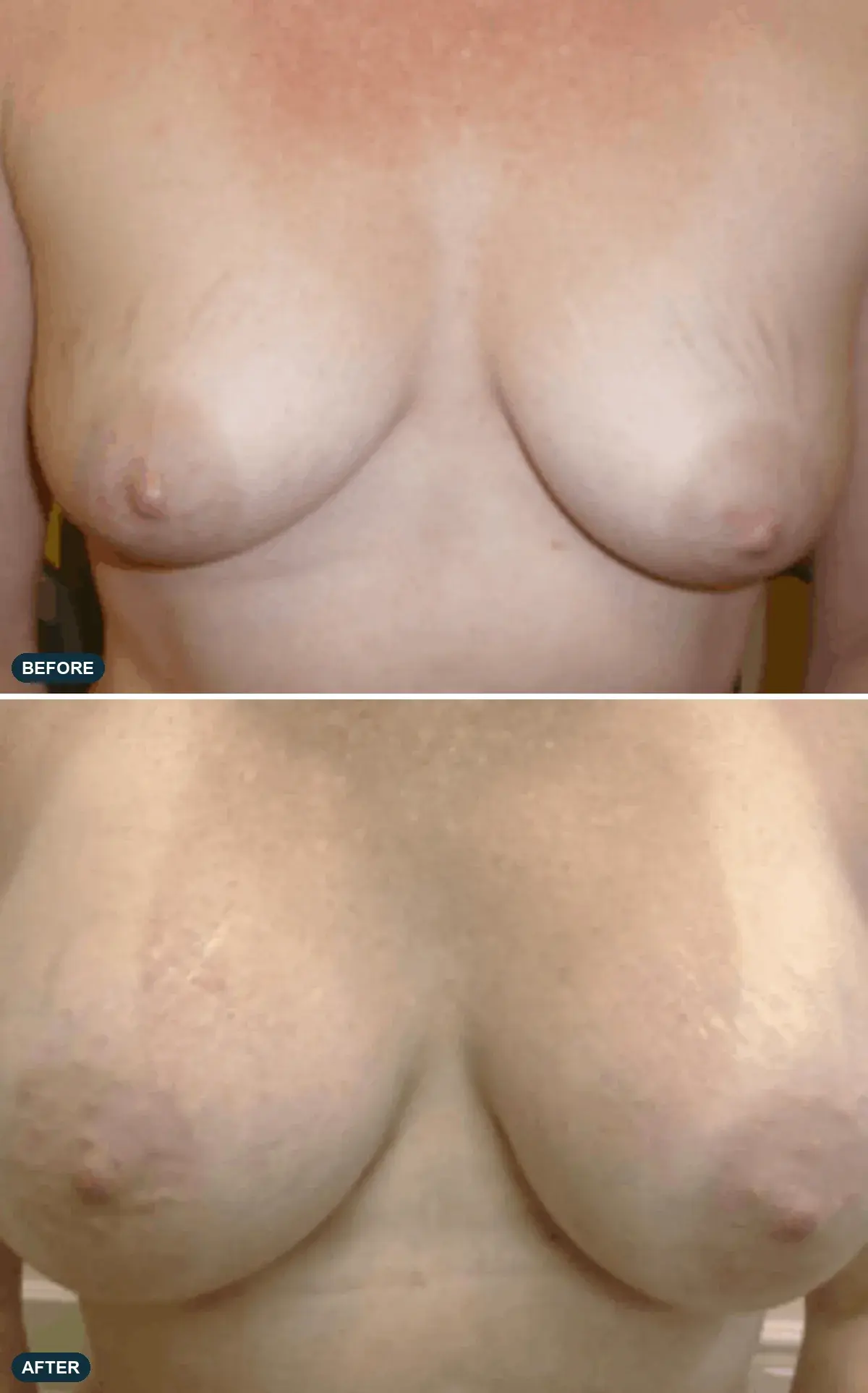 Breast, front view, before and after at Barrie Plastic Surgery