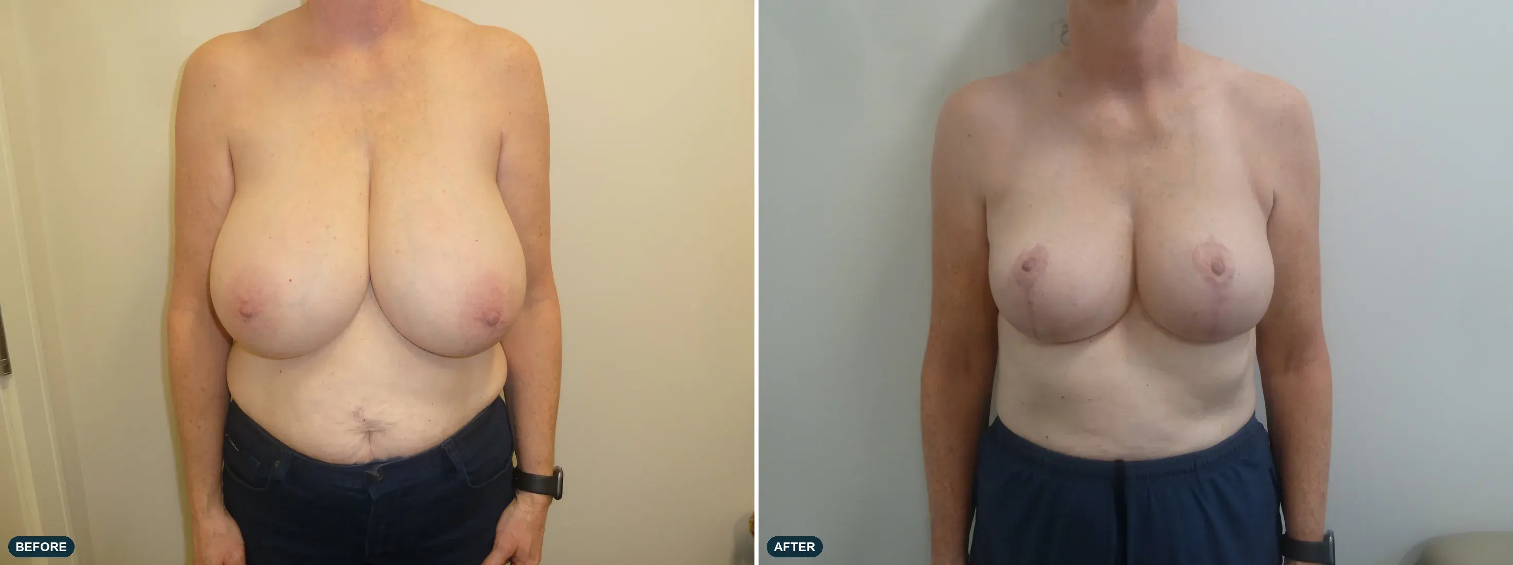 Breast, front view, before and after at Barrie Plastic Surgery