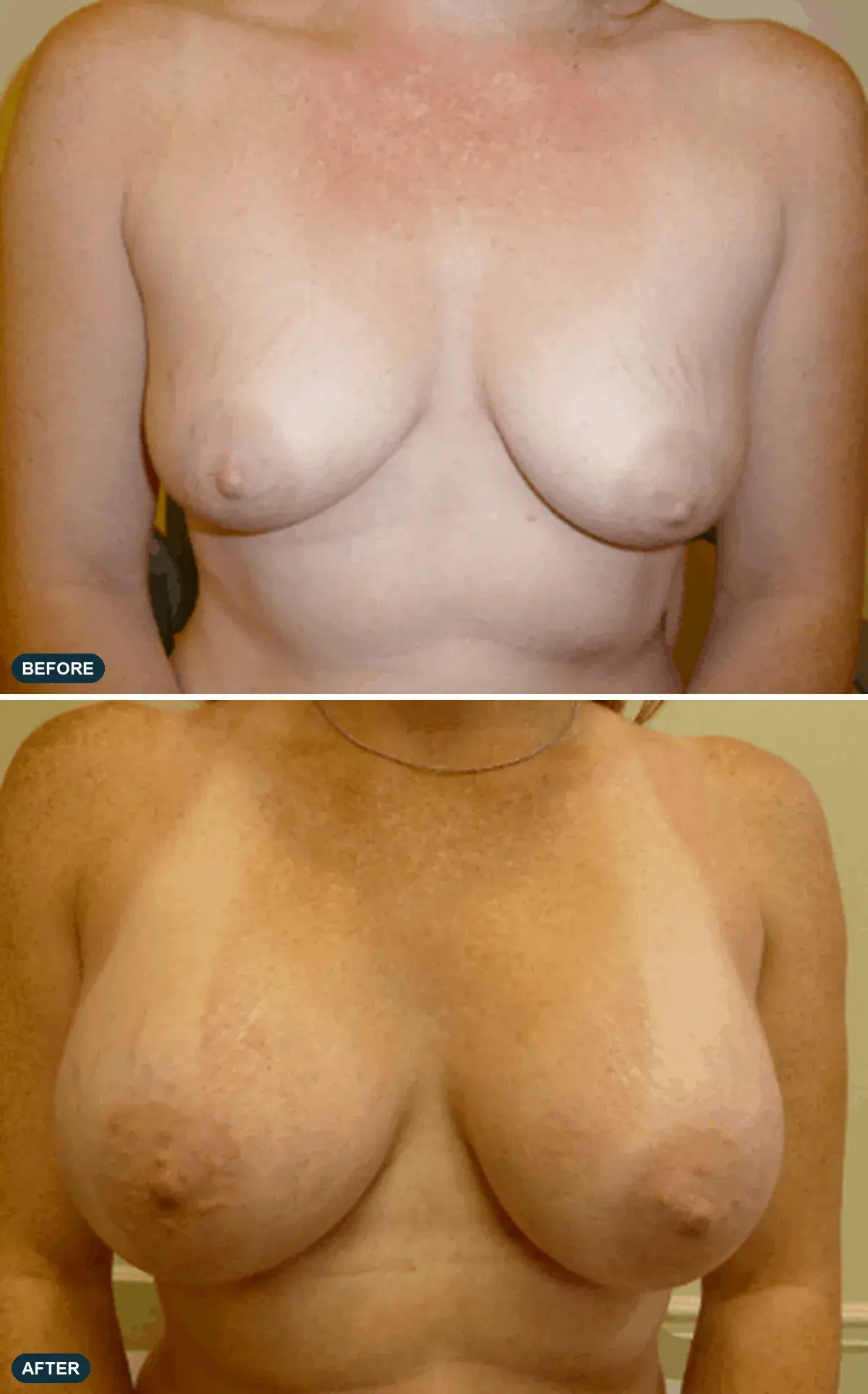 Breast, front view, before and after at Barrie Plastic Surgery