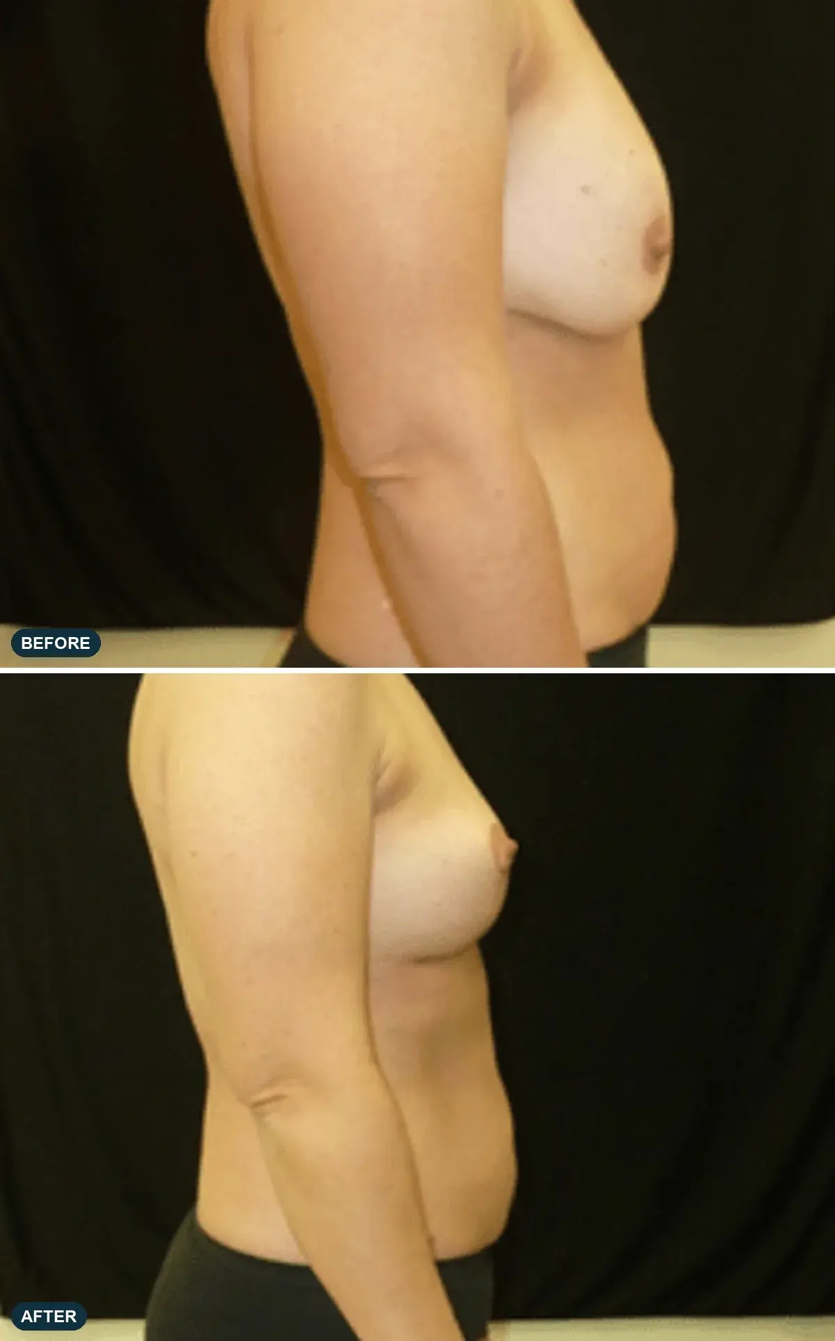 Breast, side view, before and after at Barrie Plastic Surgery