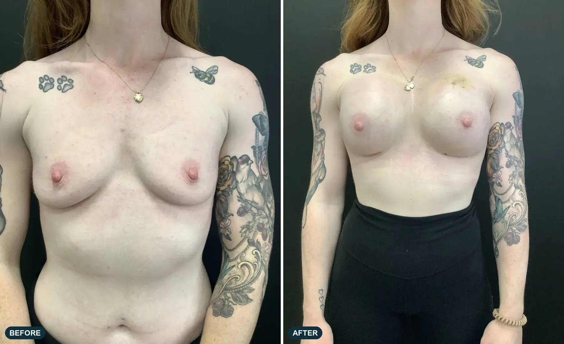 Breast, front view, before and after at Barrie Plastic Surgery