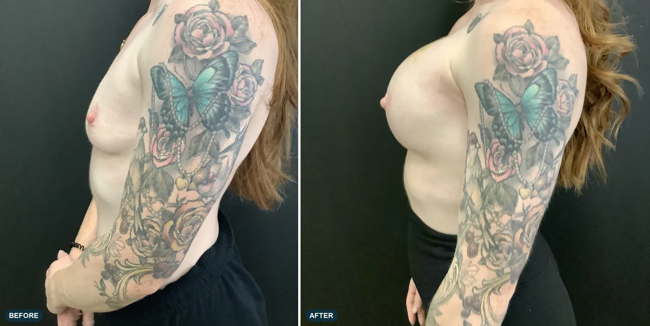 Breast, side view, before and after at Barrie Plastic Surgery