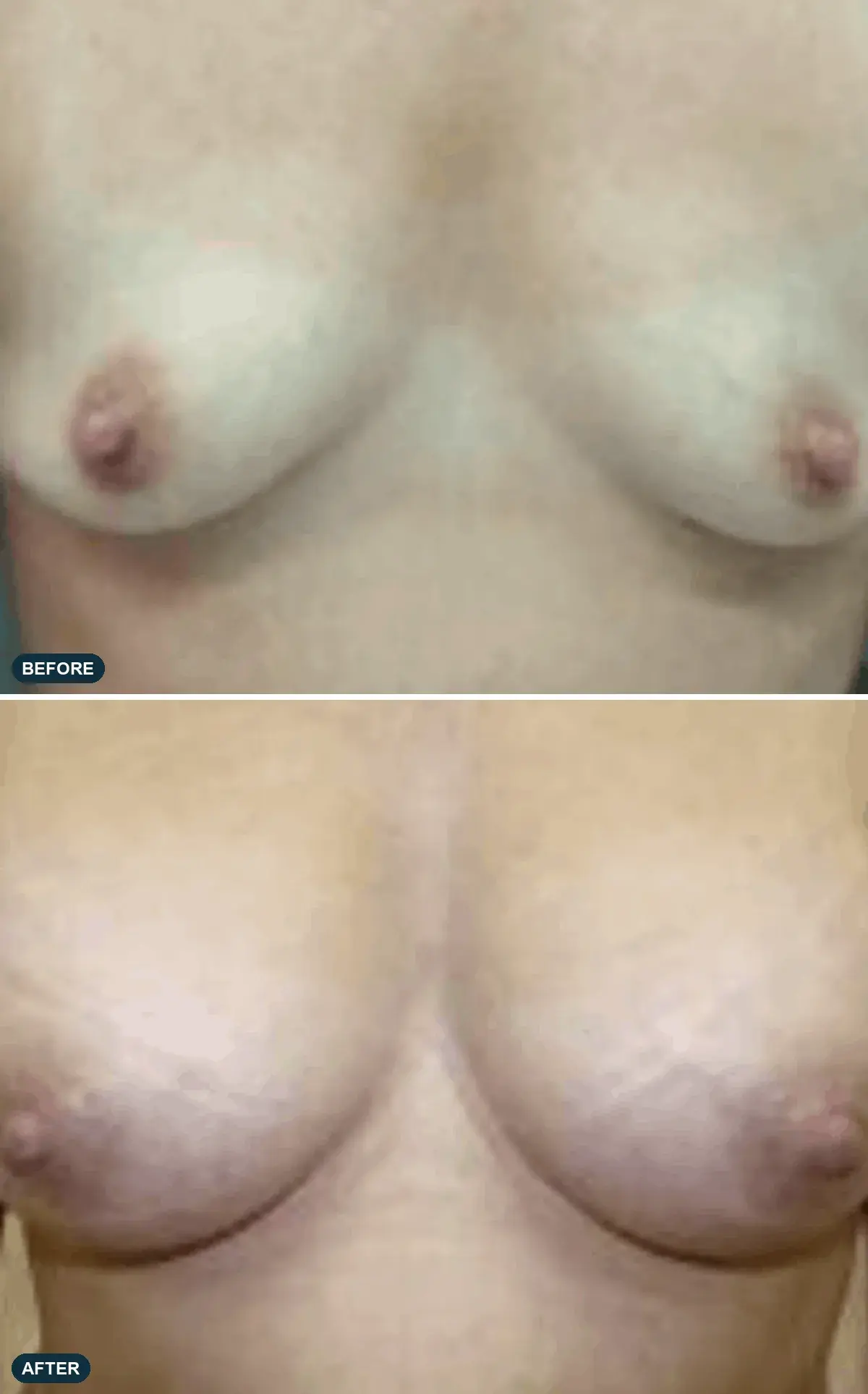 Breast, front view, before and after at Barrie Plastic Surgery