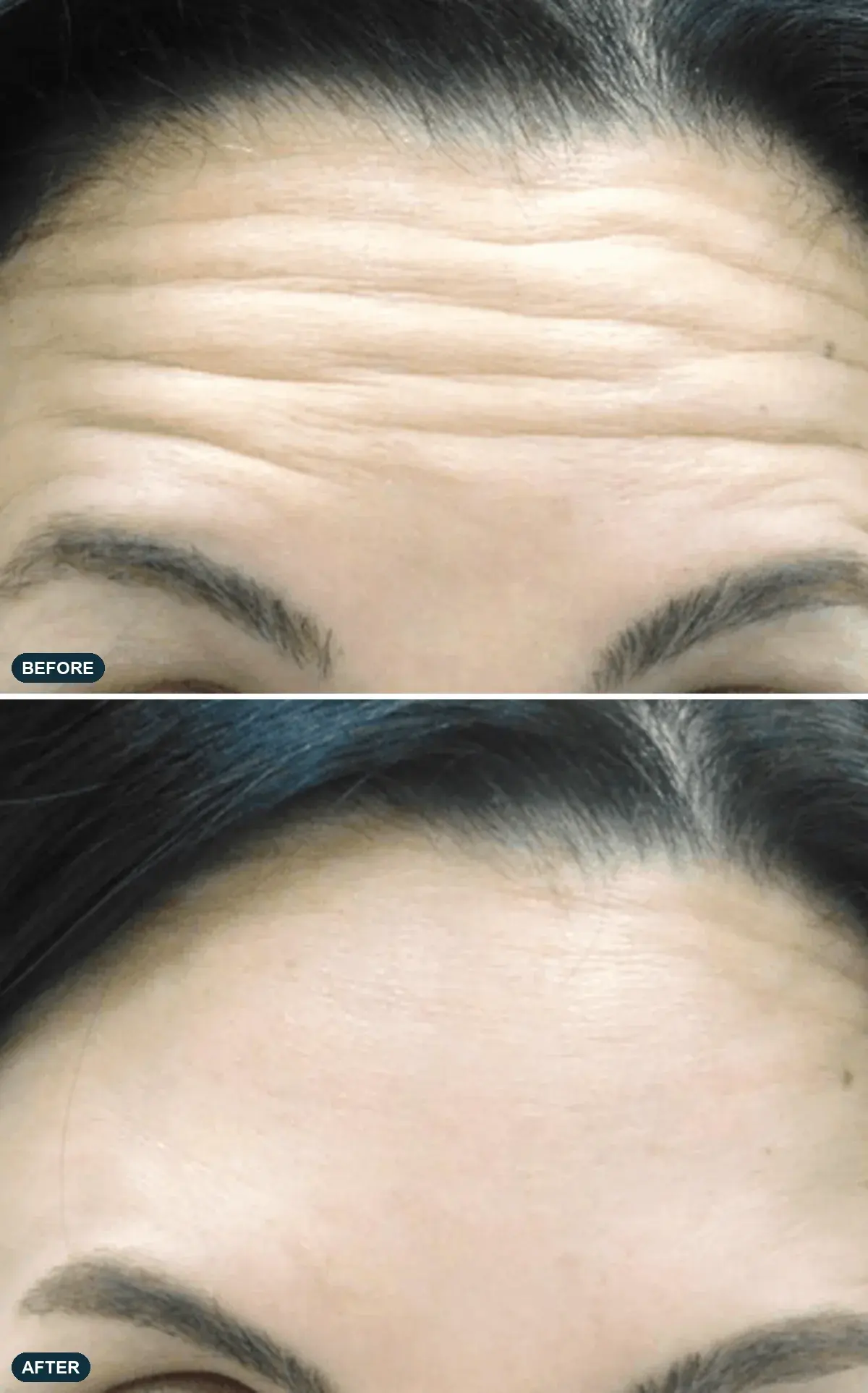 Forehead, front view, before and after clinical case supplied by the manufacturer