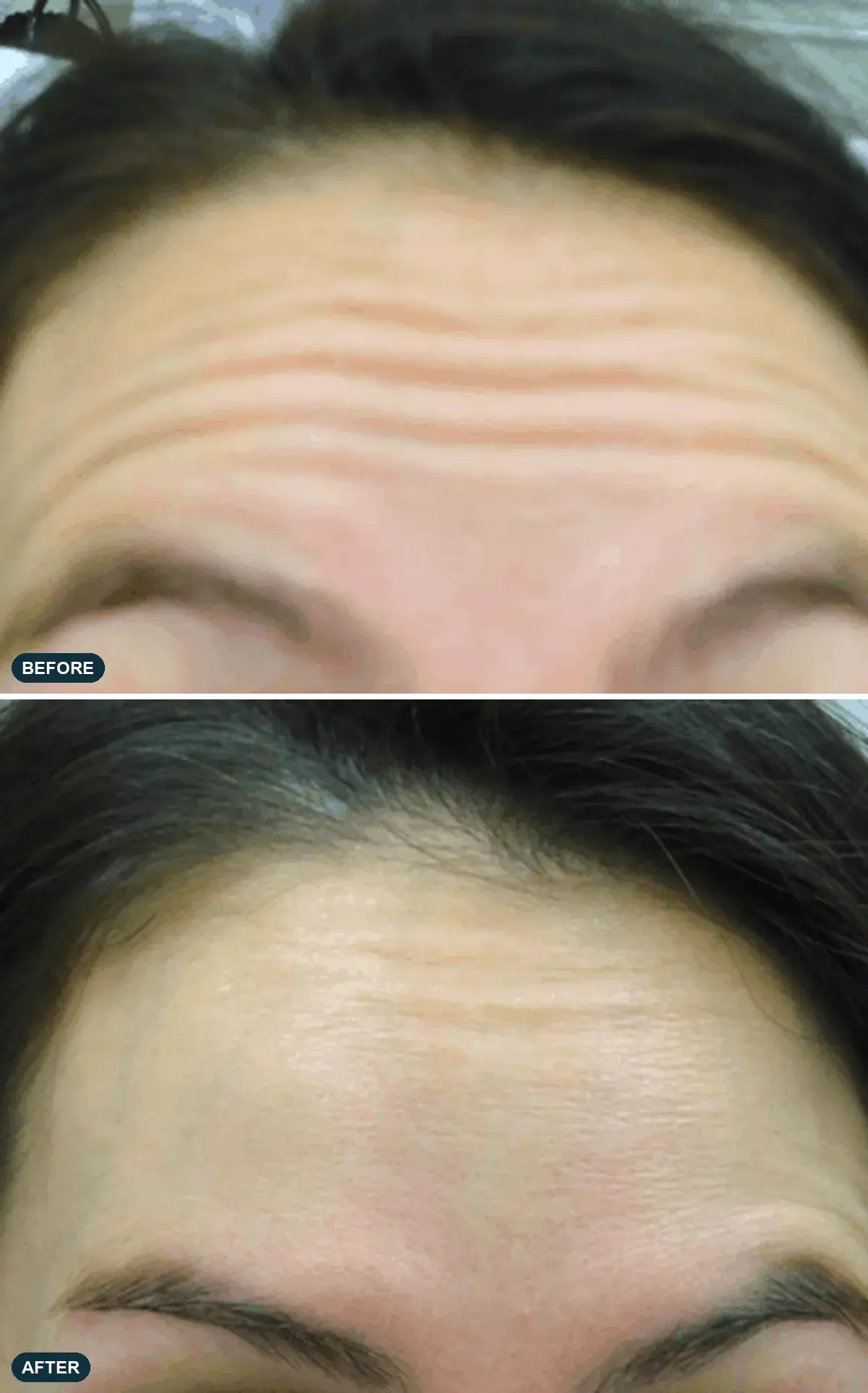 Forehead, front view, before and after clinical case supplied by the manufacturer