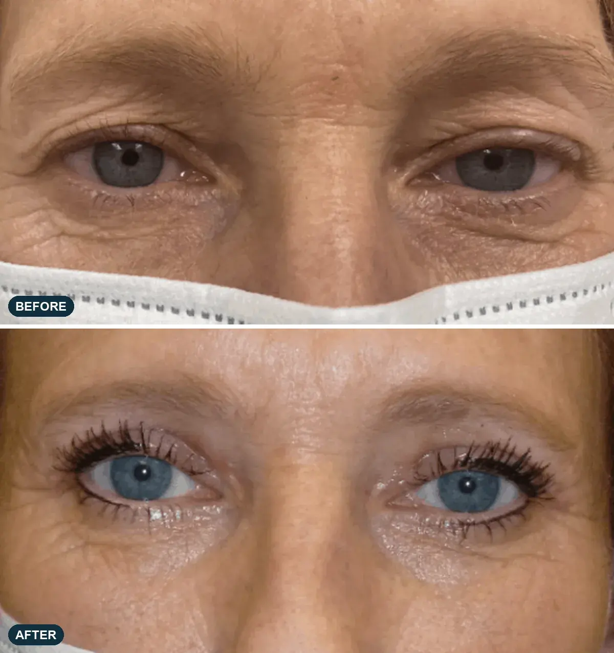 Eyelids, front view, before and after at Barrie Plastic Surgery