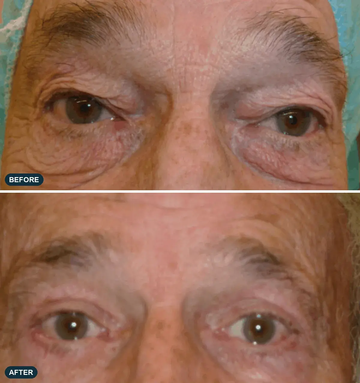 Eyelids, front view, before and after at Barrie Plastic Surgery