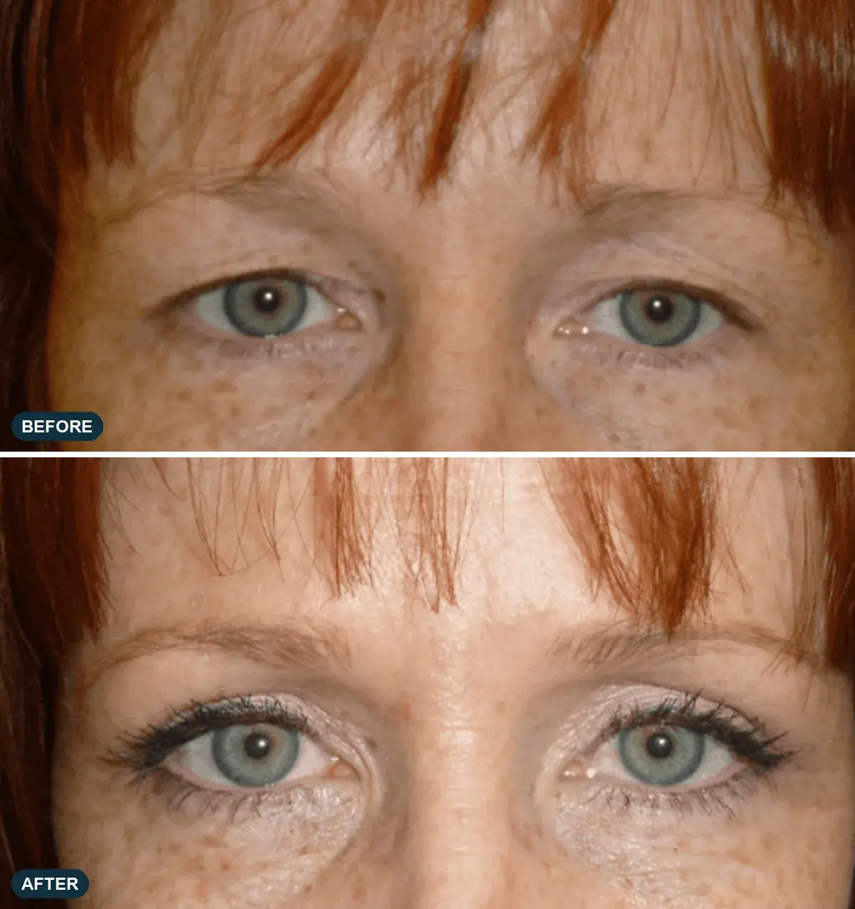 Eyelids, front view, before and after at Barrie Plastic Surgery