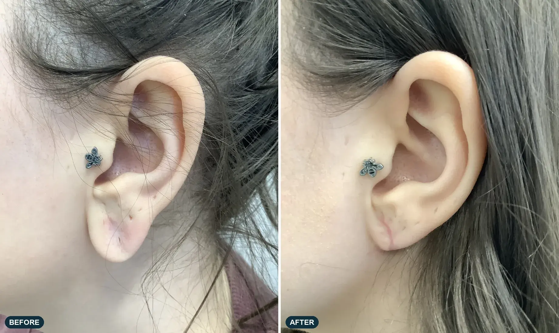 Earlobe, side view, before and after at Barrie Plastic Surgery