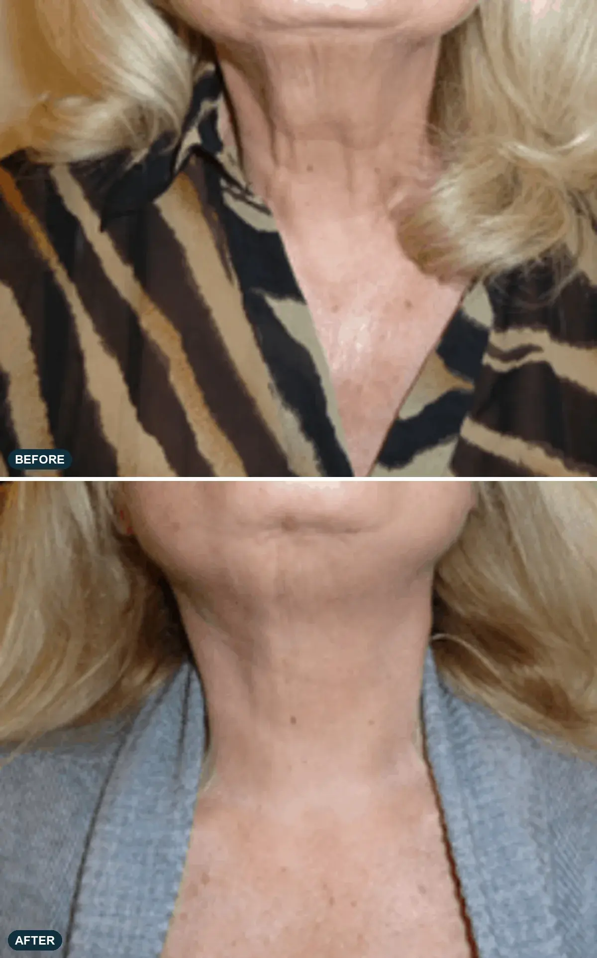 Neck, front view, before and after at Barrie Plastic Surgery