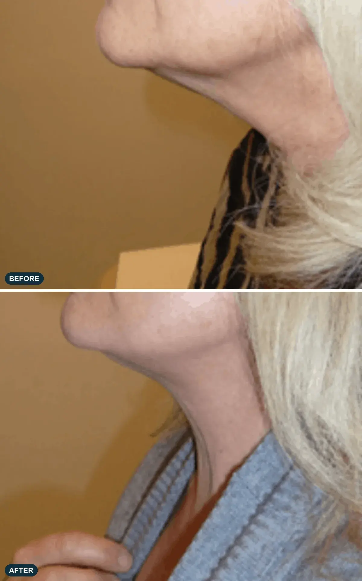Neck, side view, before and after at Barrie Plastic Surgery