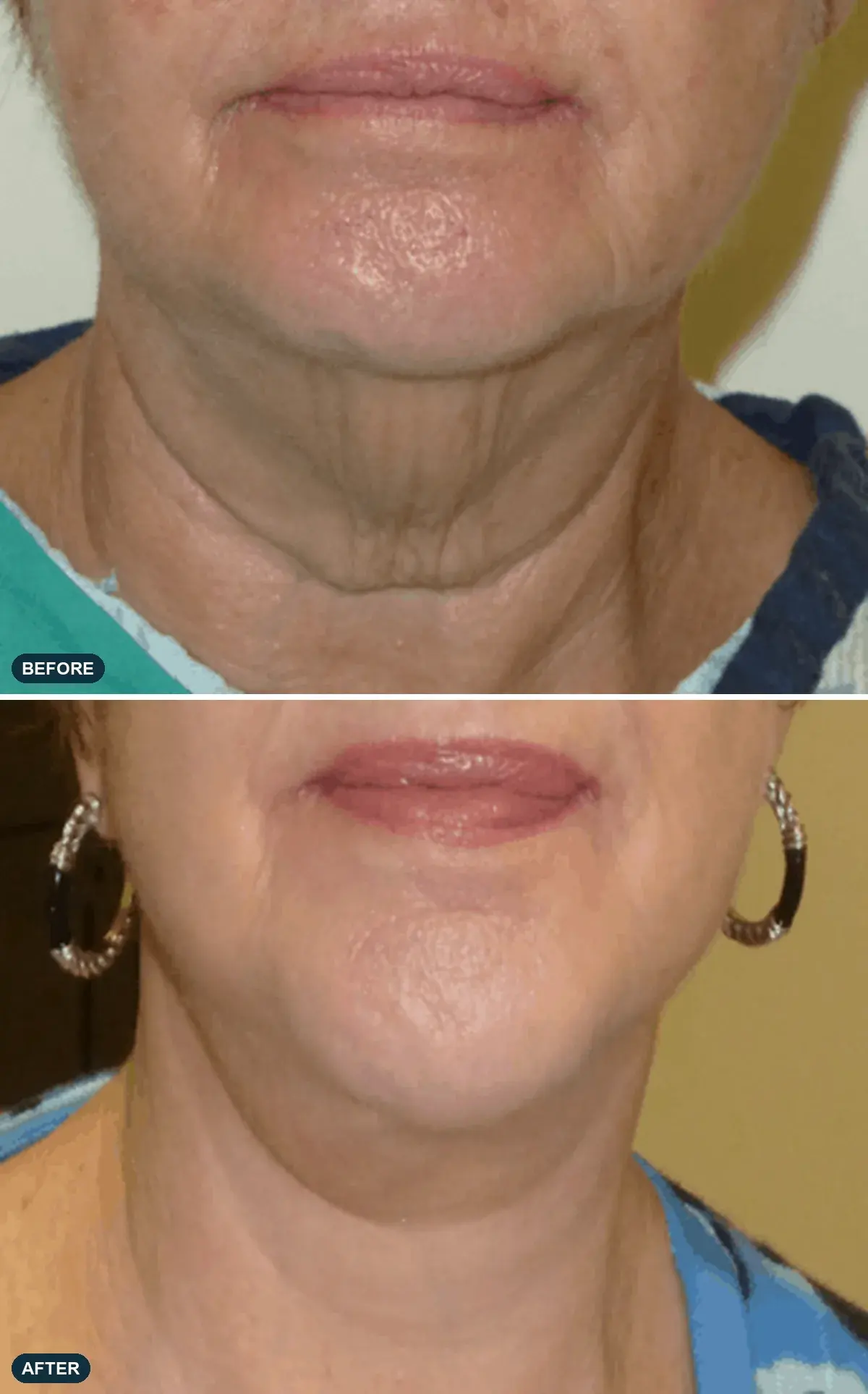 Neck, front view, before and after at Barrie Plastic Surgery