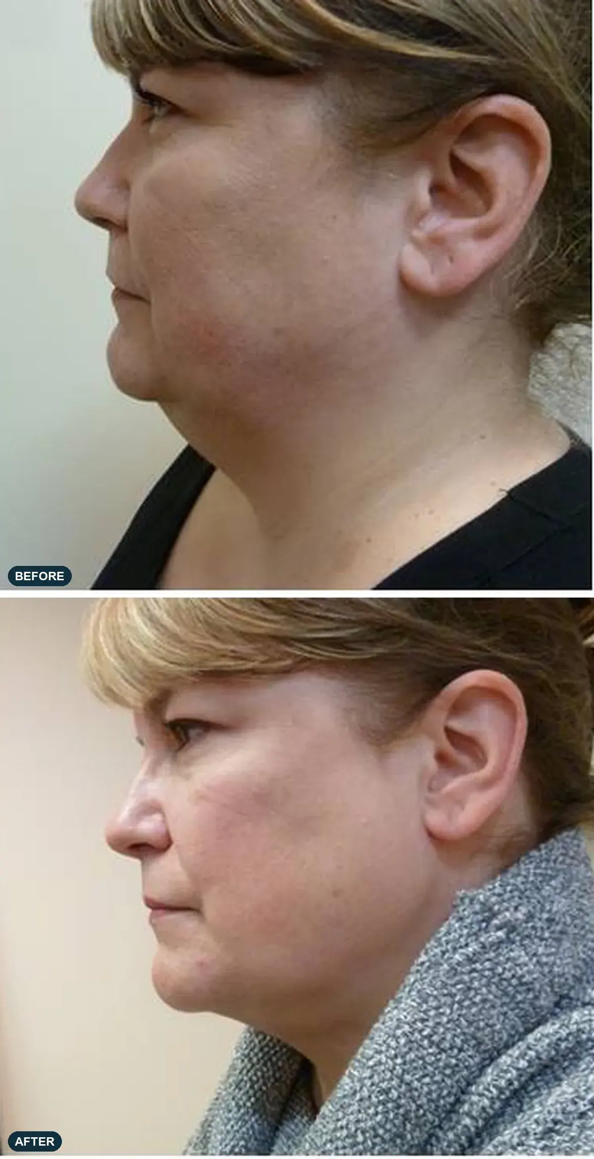 Under the Chin, side view, before and after at Barrie Plastic Surgery
