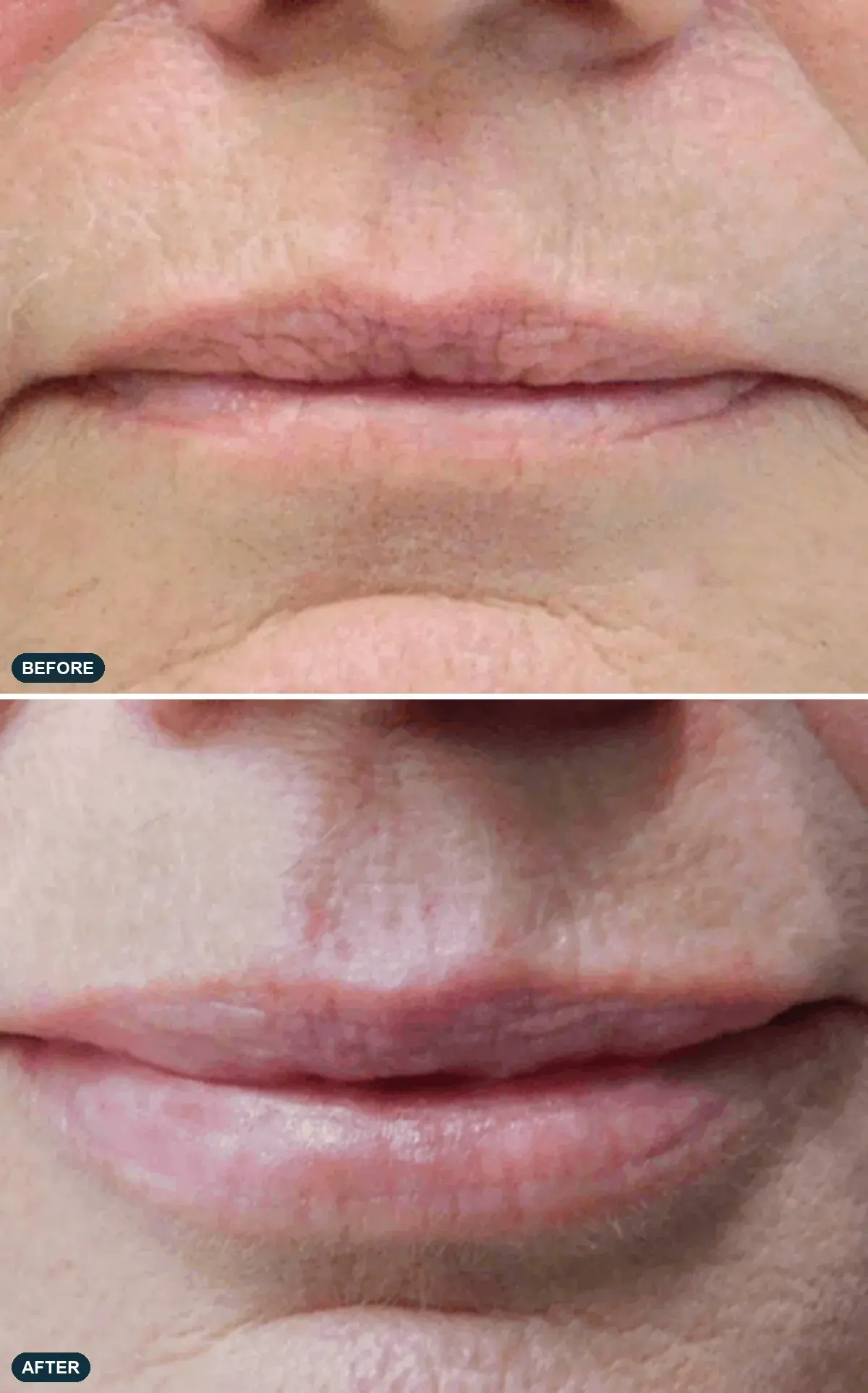 Lips, front view, before and after clinical case supplied by the manufacturer