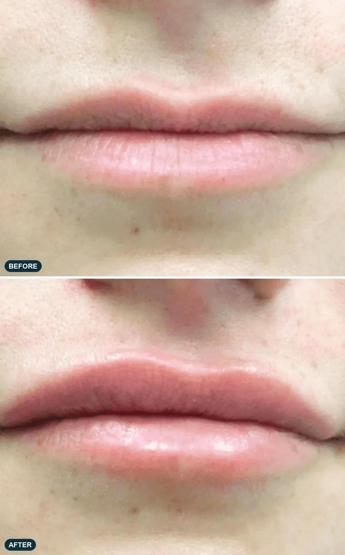 Lips, front view, before and after clinical case supplied by the manufacturer